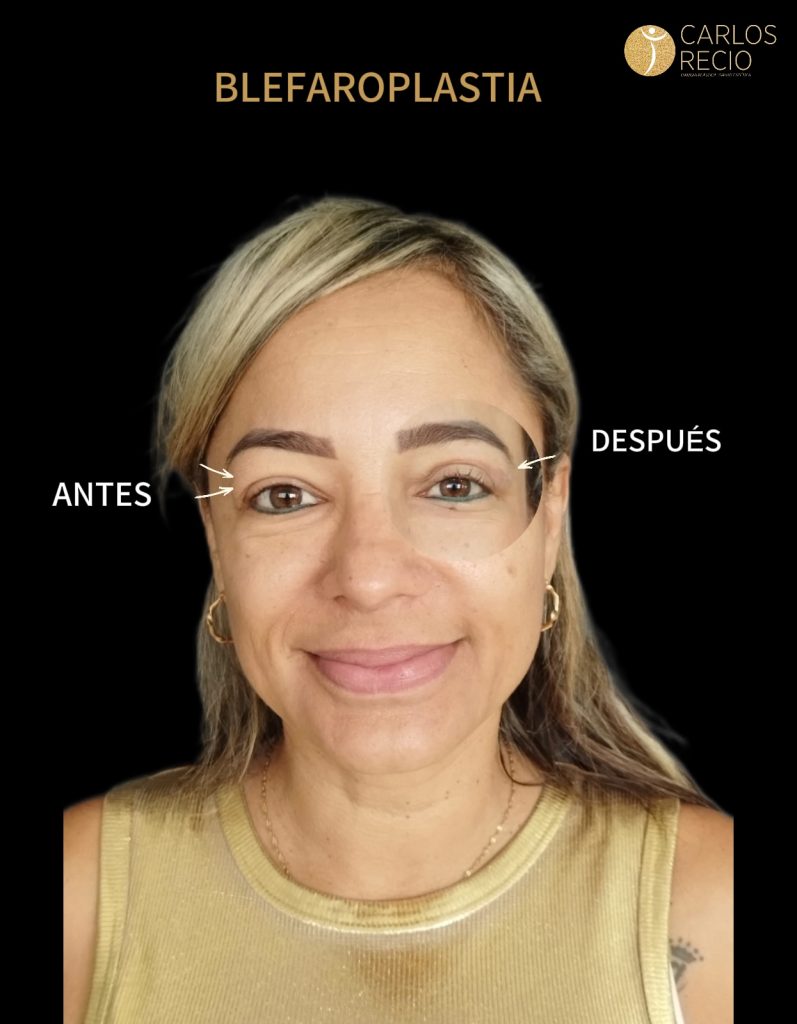 Blefaroplastia en Cali: precio y cómo rejuvenecer la mirada con el Dr. Carlos Recio