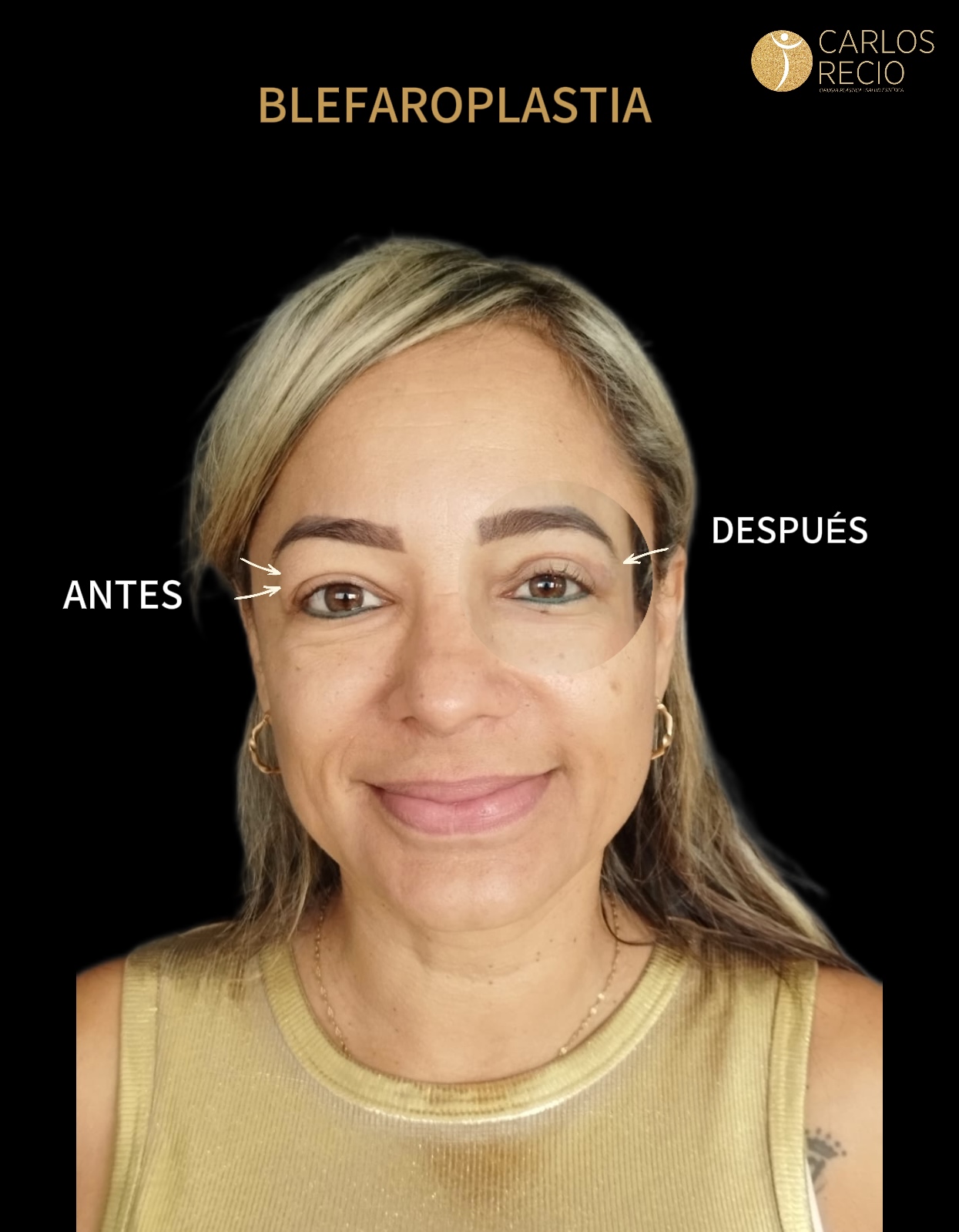 blefaroplastia en Cali