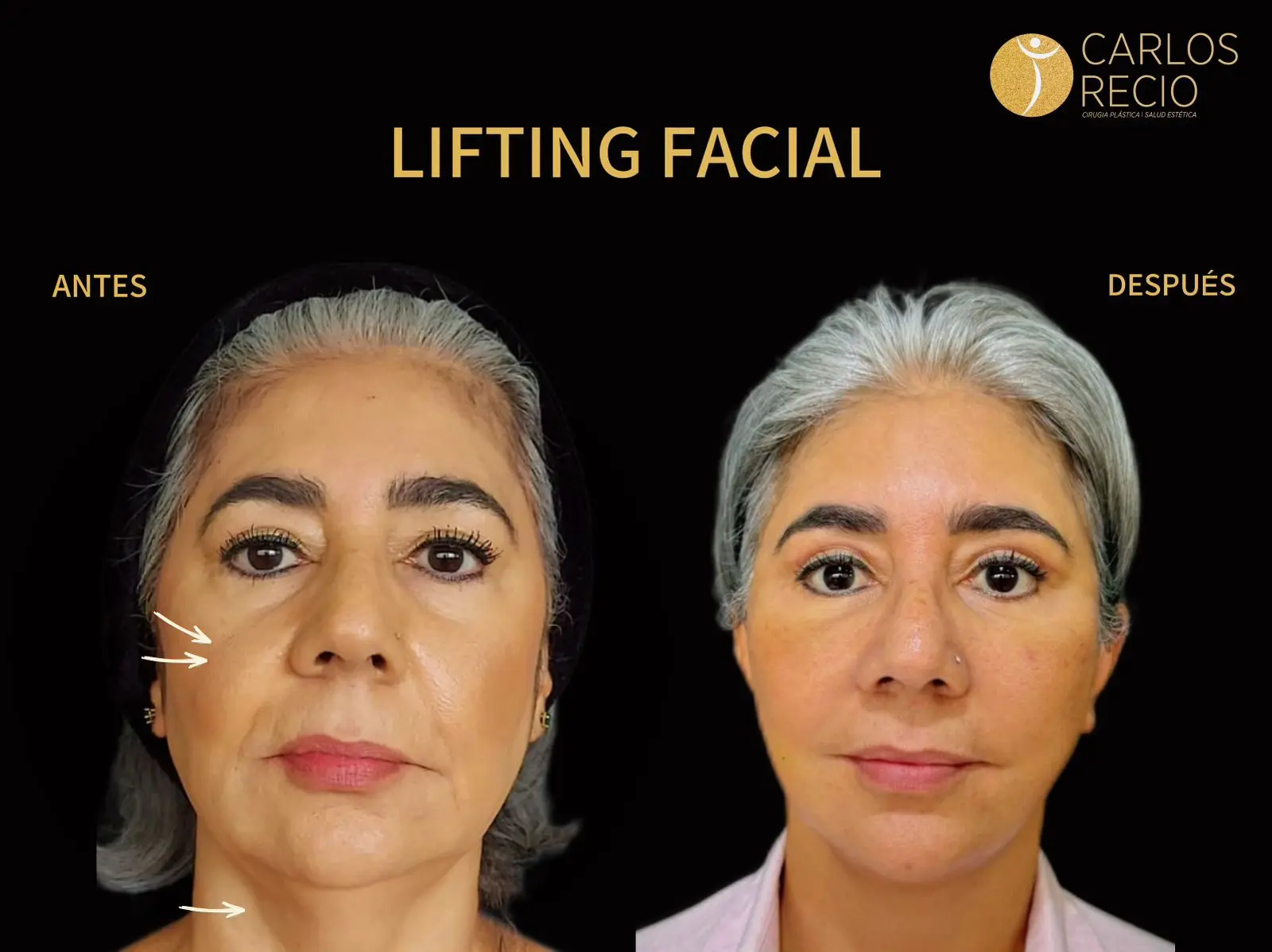 procedimientos faciales en Cali DEEP PLANE