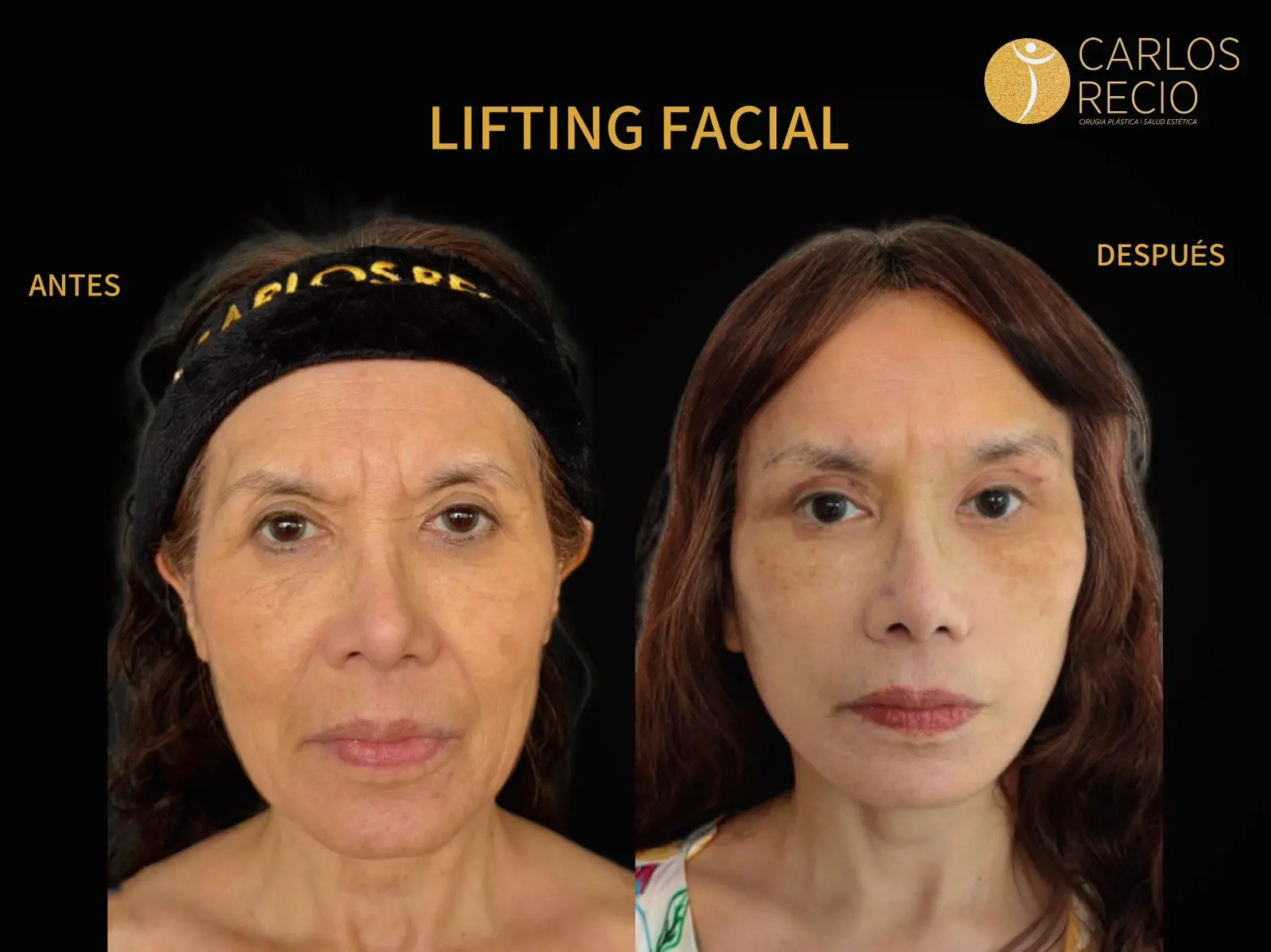 procedimientos faciales en Cali Estiramiento facial