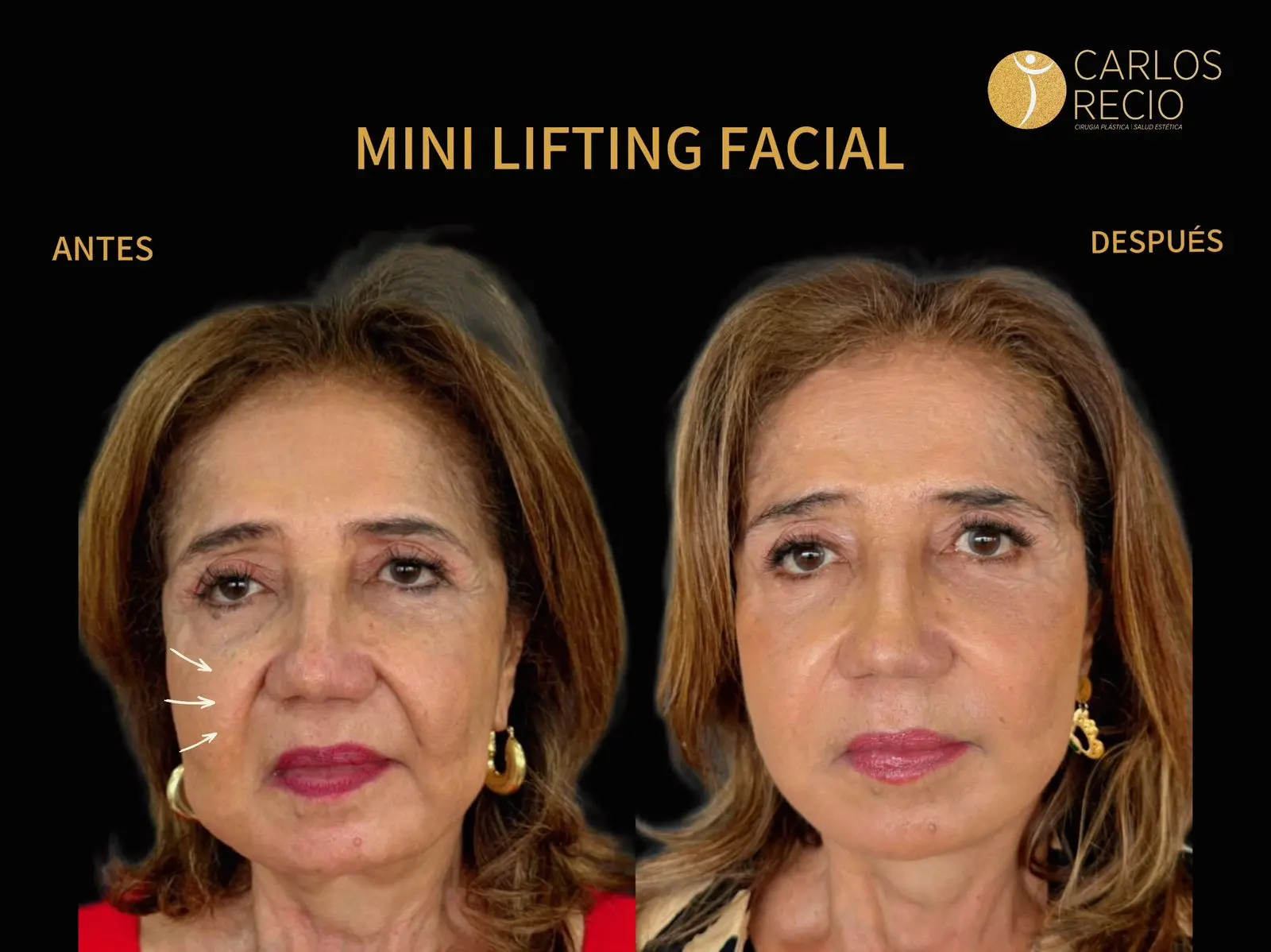 Estiramiento facial Face lift
