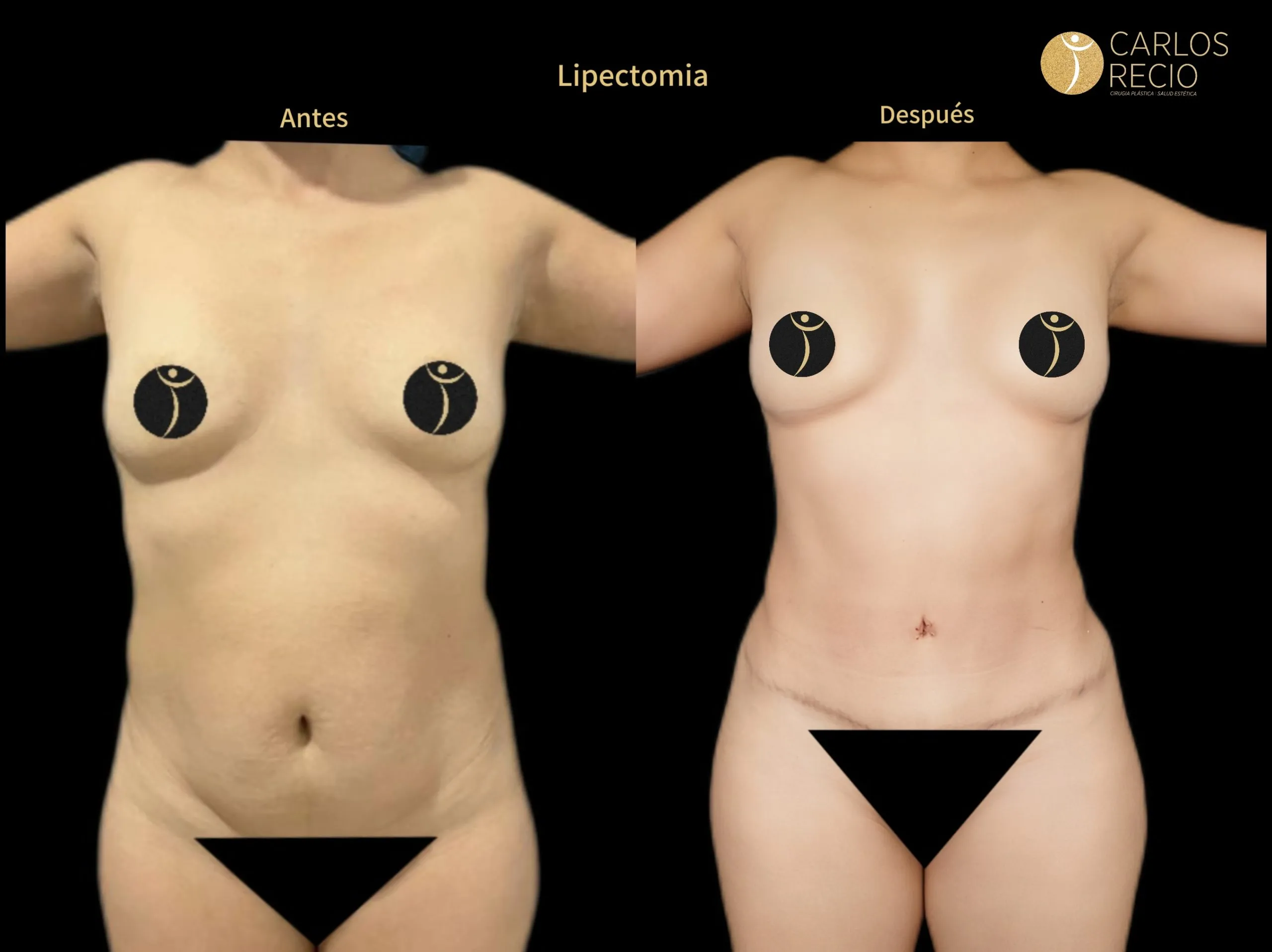 Abdominoplastia en Cali IMG_3733-scaled