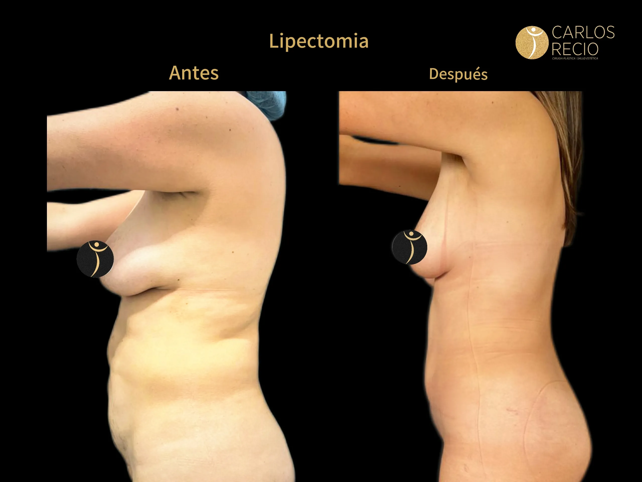 Abdominoplastia en Cali IMG_3735