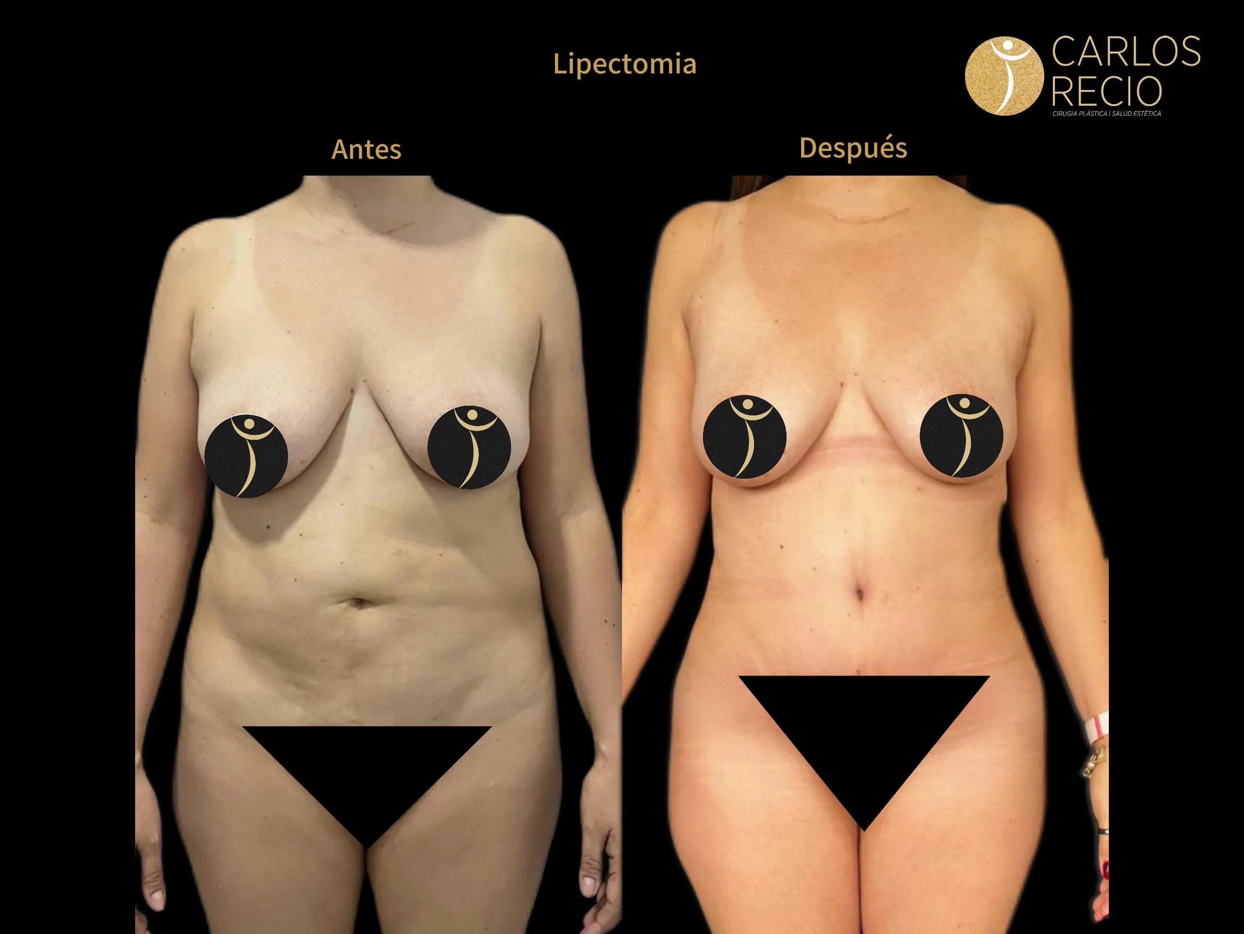 Abdominoplastia en Cali IMG_3784