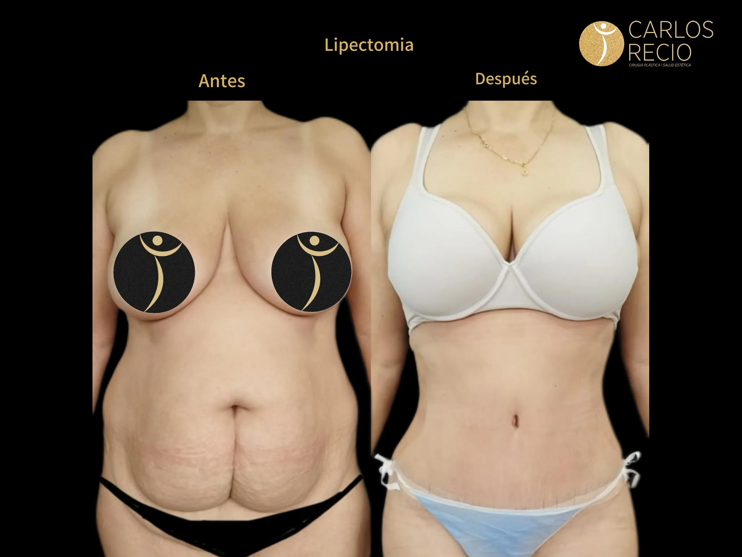 Abdominoplastia en Cali IMG_3829