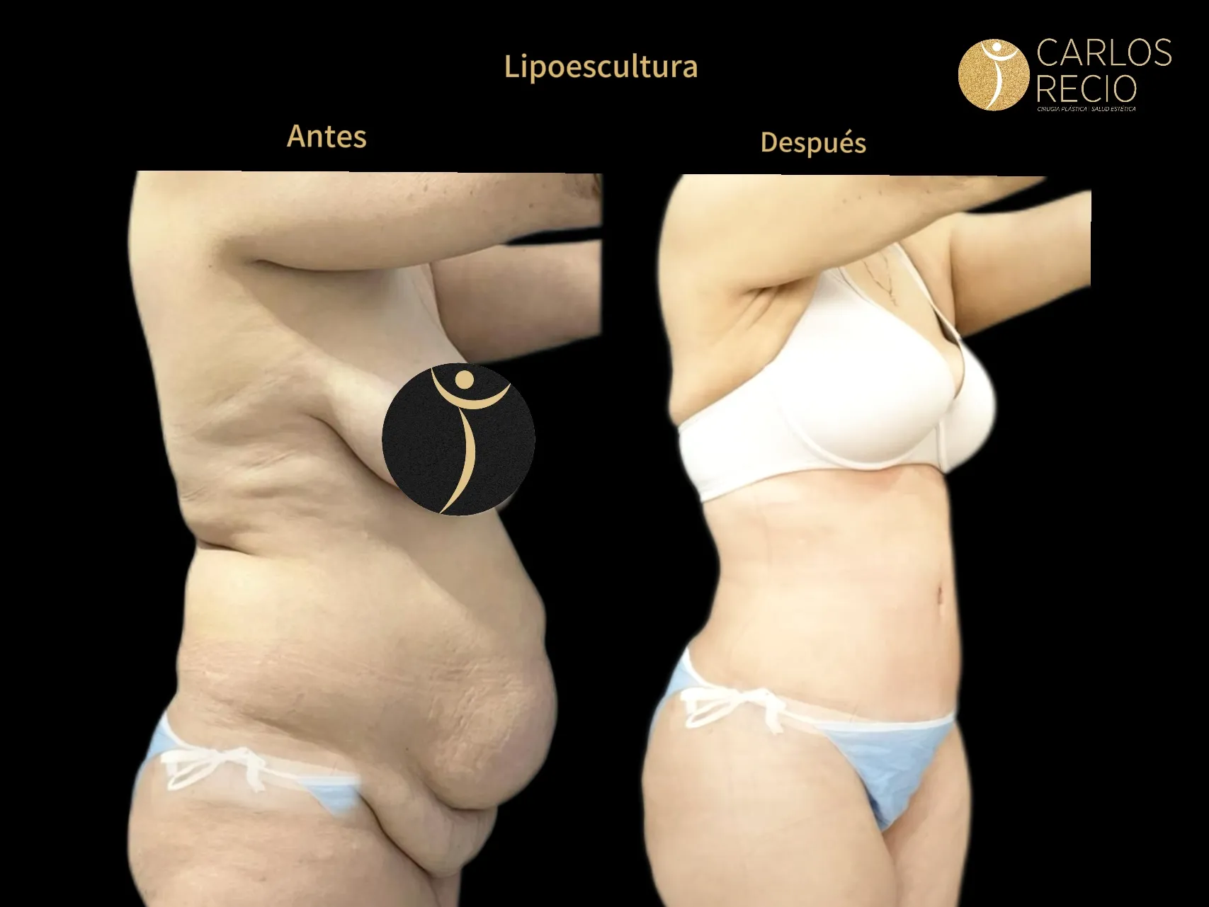 Abdominoplastia en Cali IMG_3831