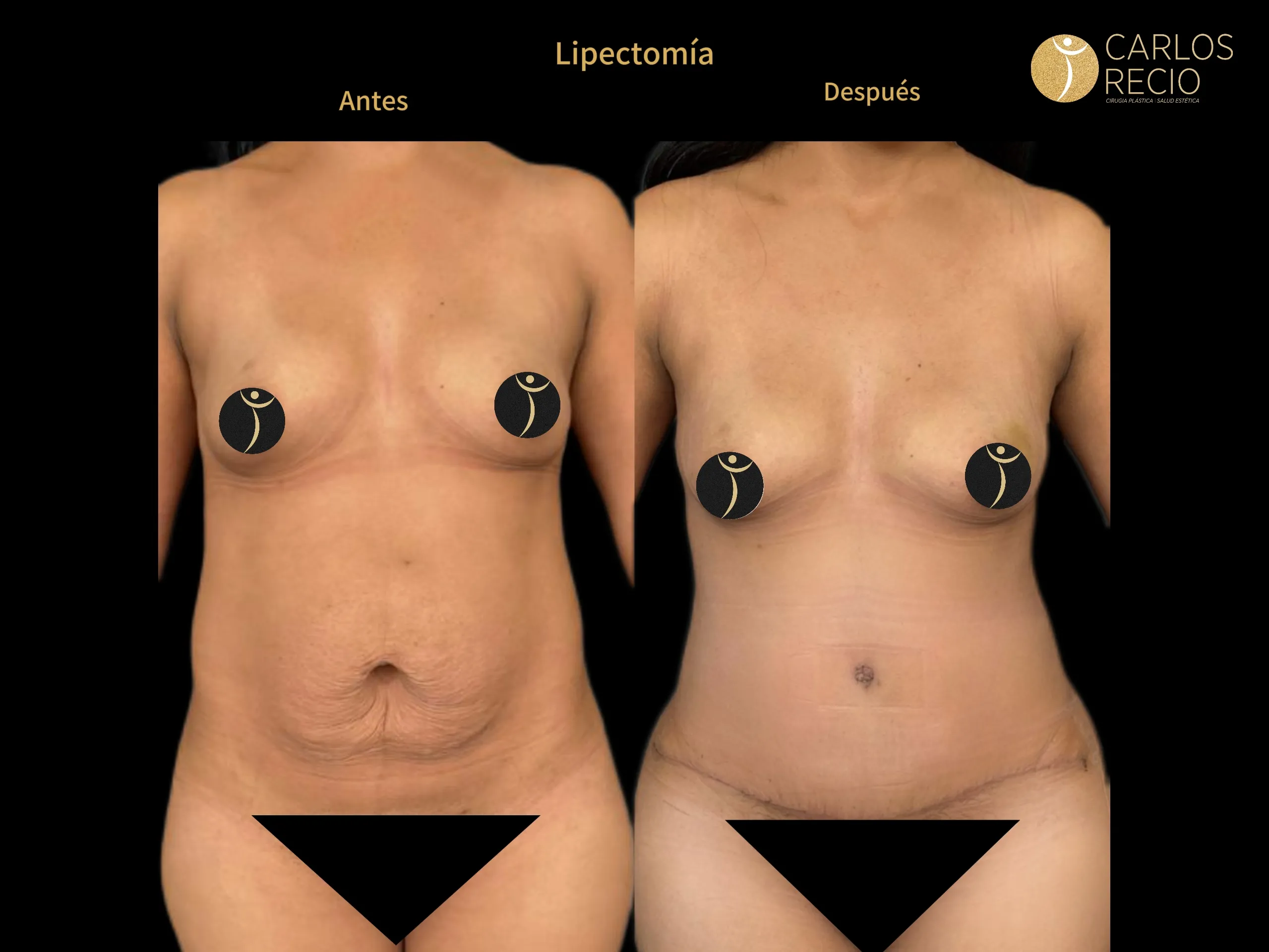 Abdominoplastia en Cali IMG_3833-1