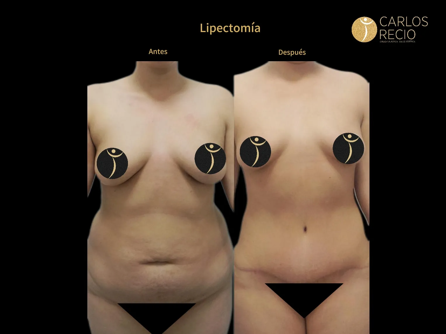 Abdominoplastia en Cali IMG_3876