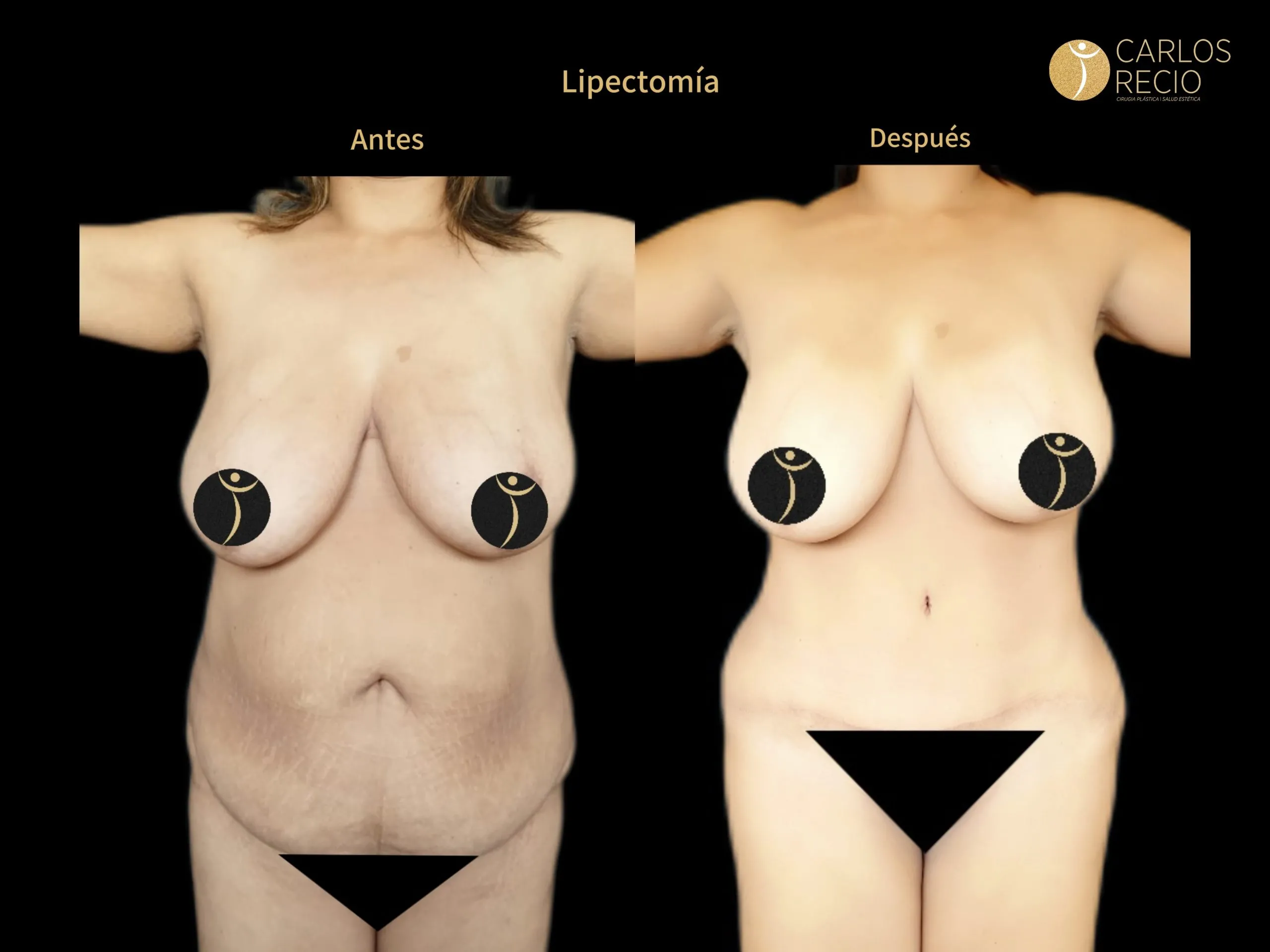 Abdominoplastia en Cali IMG_3893-scaled