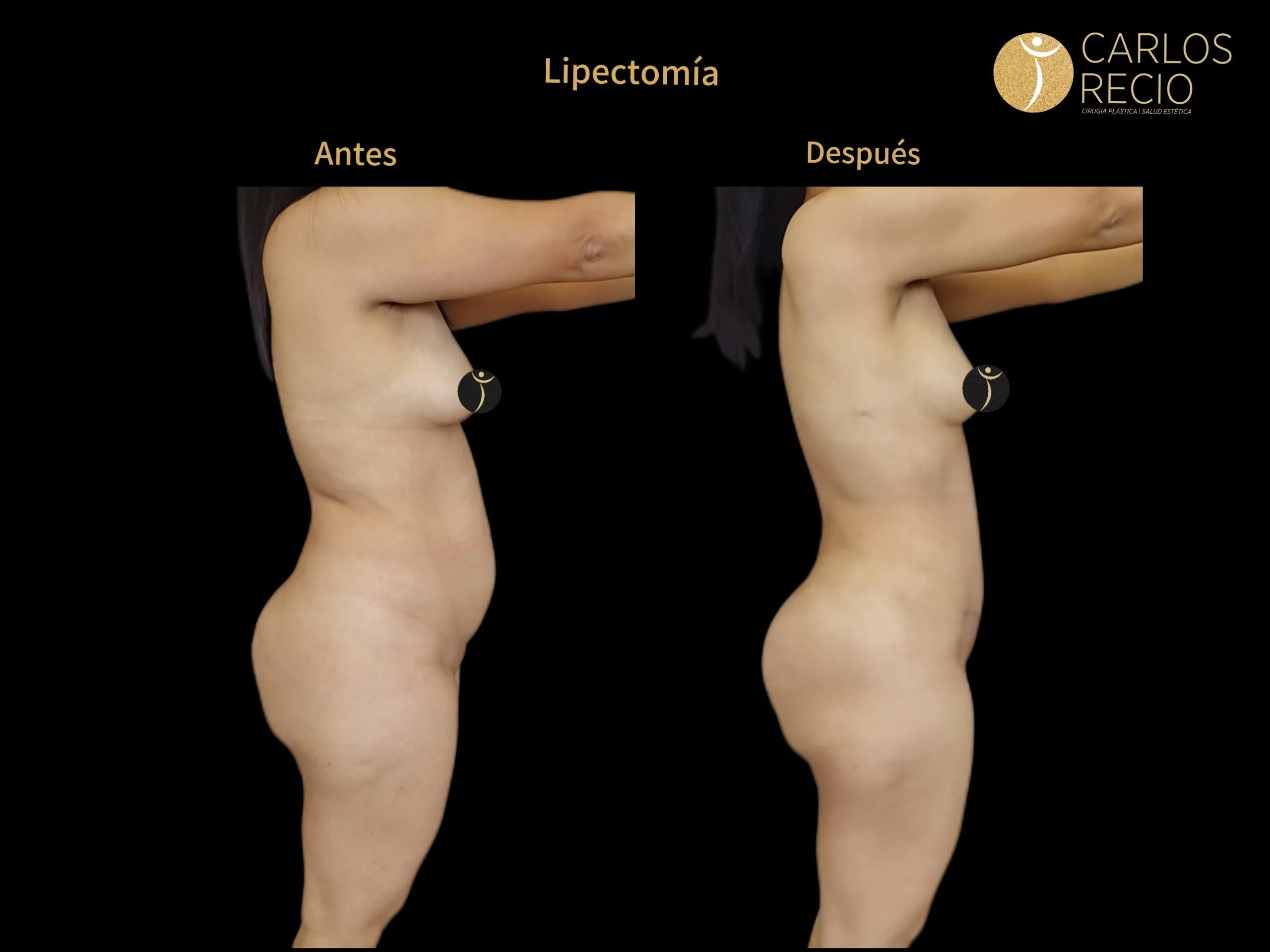 Abdominoplastia en Cali IMG_3948-scaled (1)