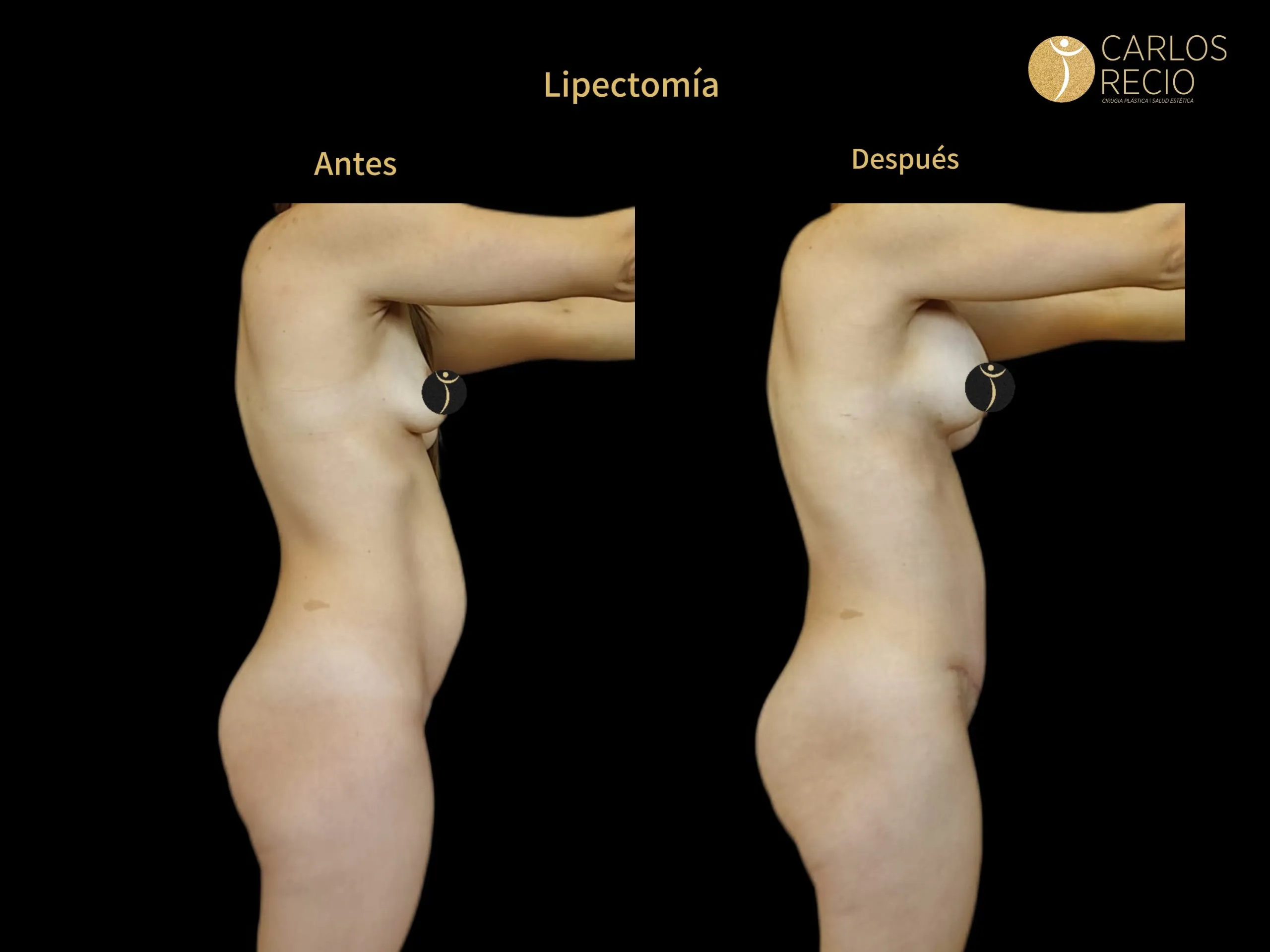 Abdominoplastia en Cali IMG_3967-scaled