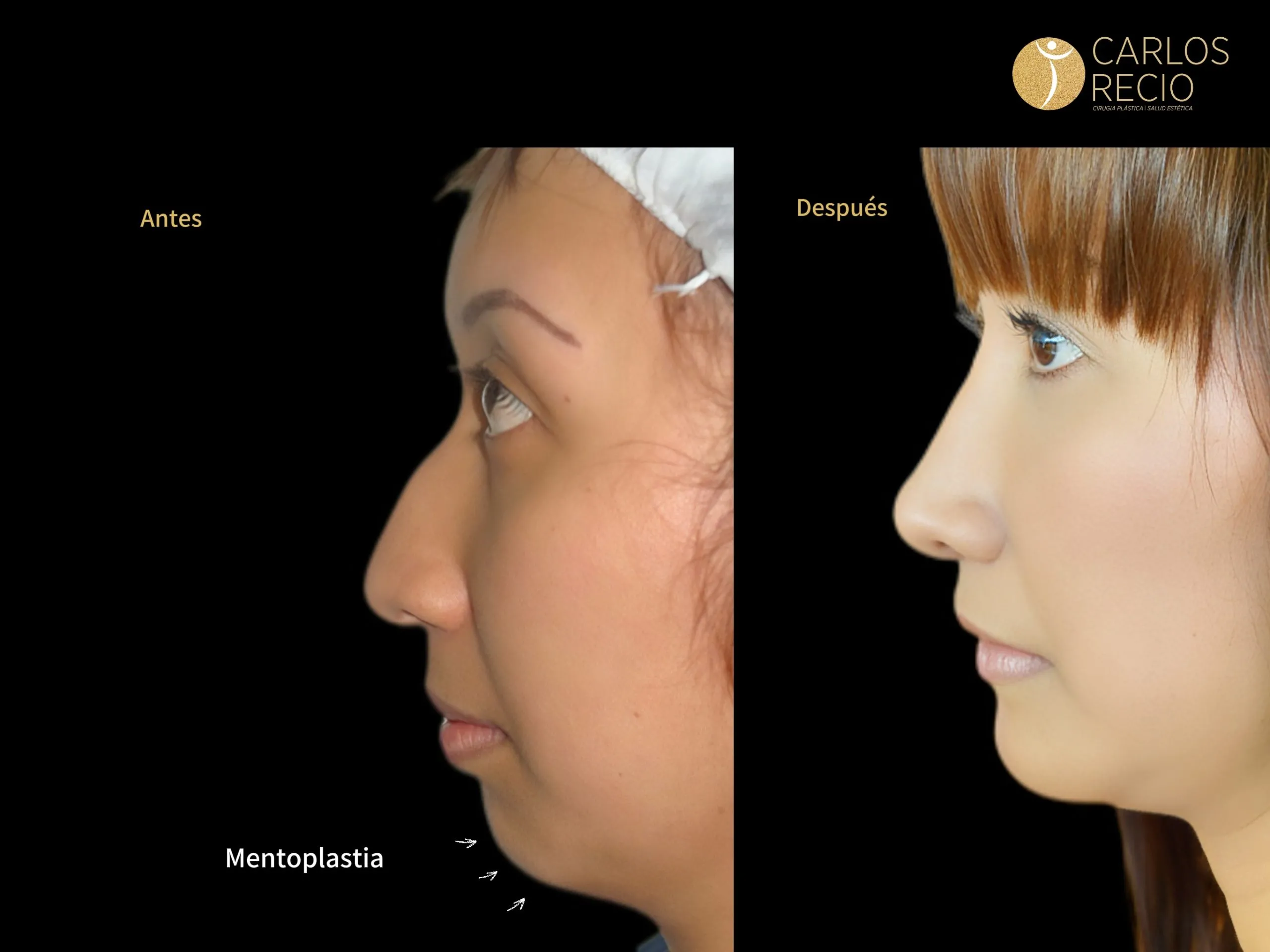 Cirugia de Menton - Mentoplastia IMG_4628-scaled