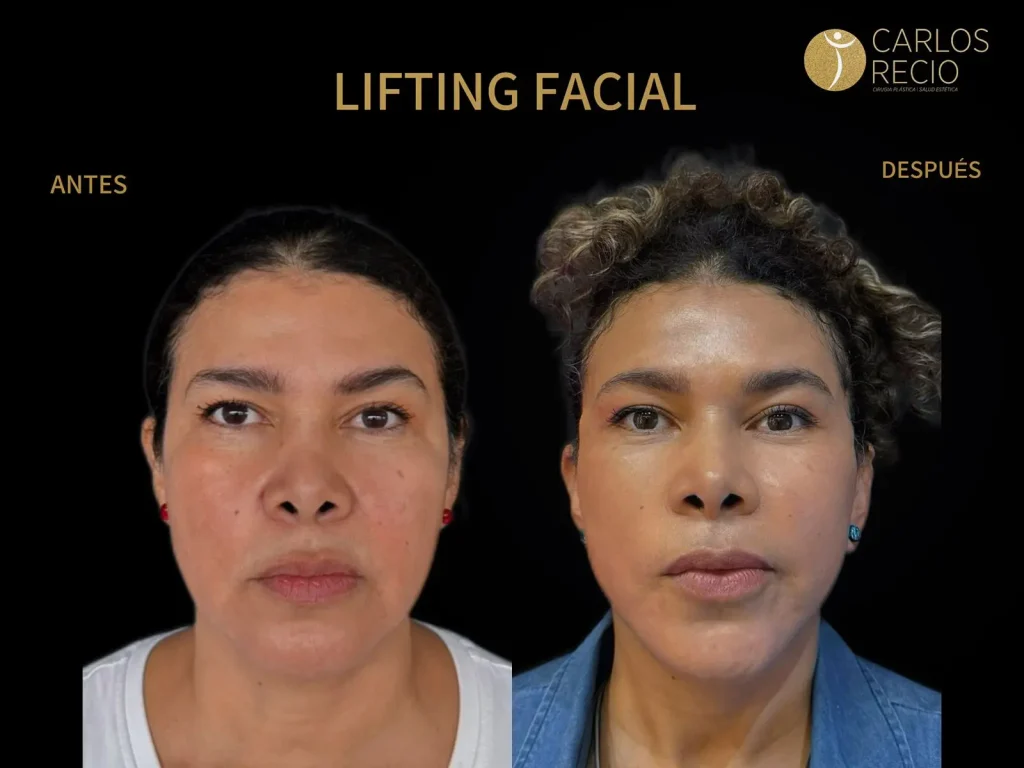 Deep Plane Facelift: qué es, por qué da resultados más naturales y quién es candidato ideal Deep Plane Facelift: qué es, por qué da resultados más naturales y quién es candidato ideal