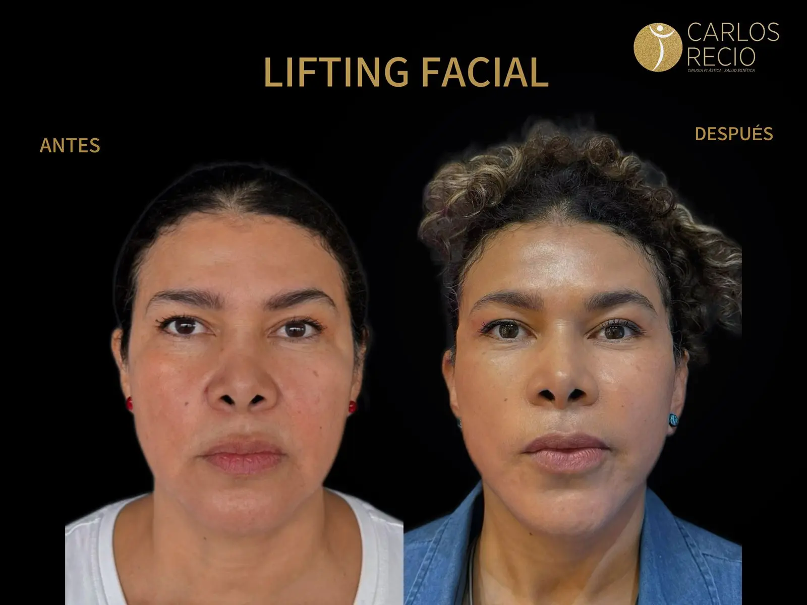 procedimientos faciales en Cali lifting facial