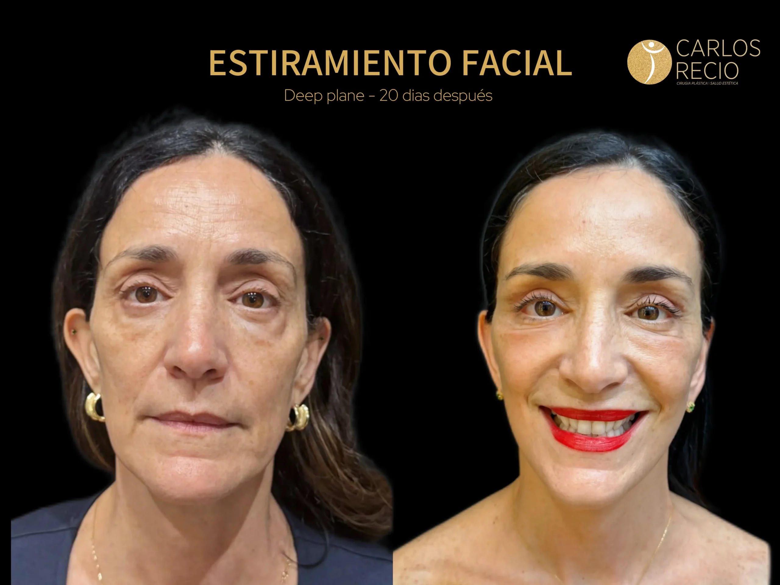 Estiramiento facial Lifting facial