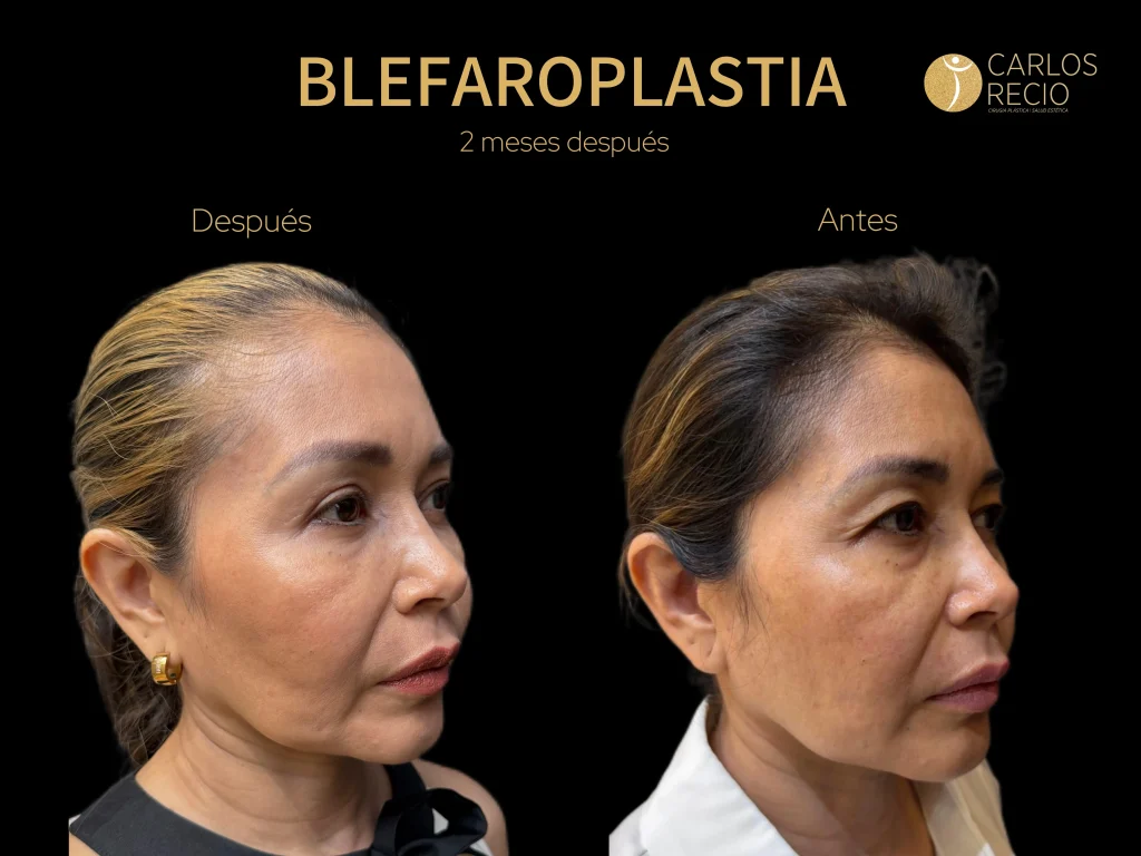 Blefaroplastia inferior: qué es, técnica y recuperación Dr. Recio