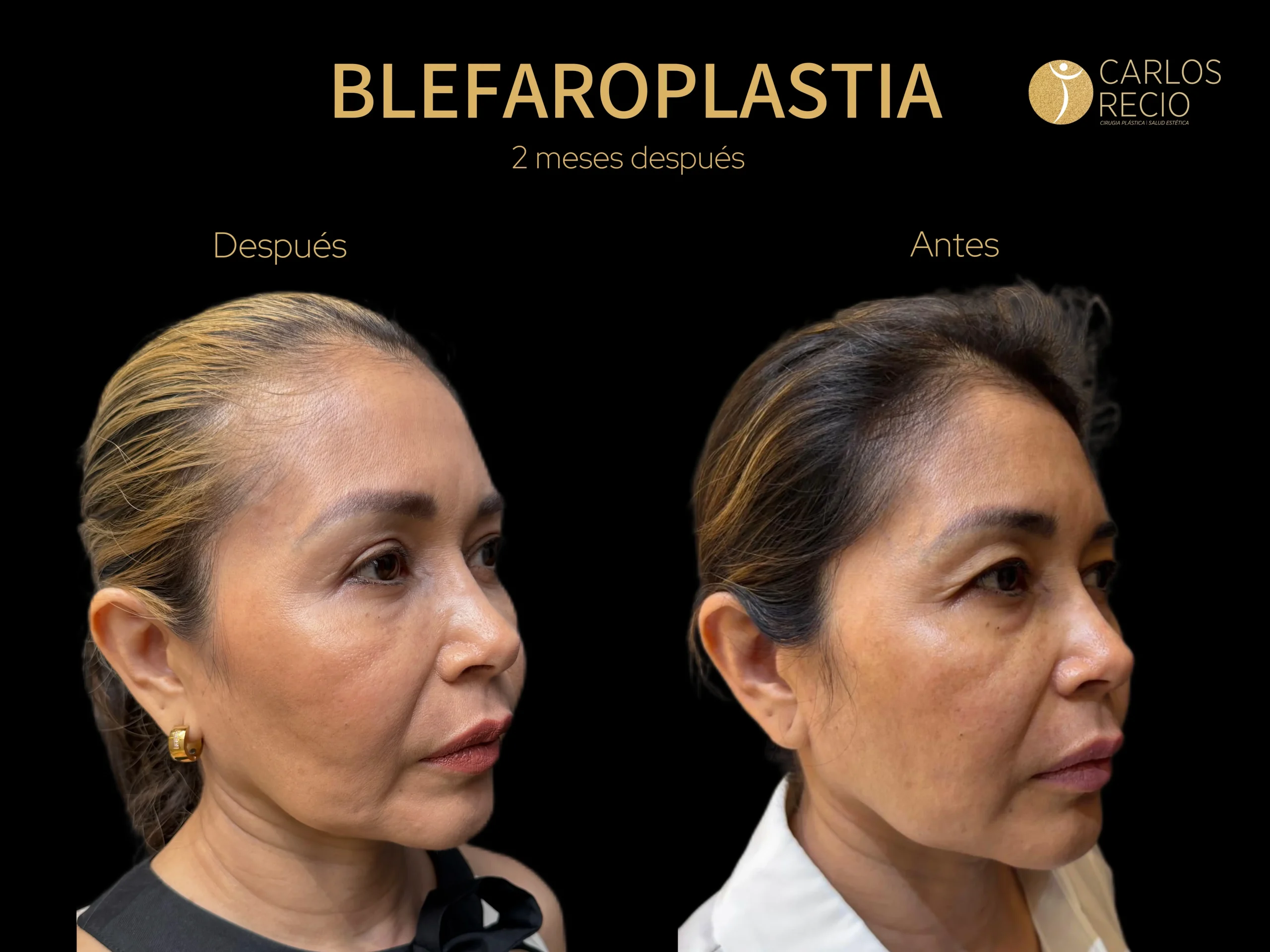procedimientos faciales en Cali Dr. Recio