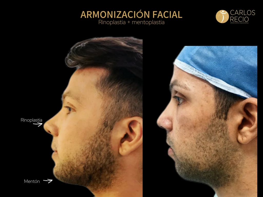 Cirugía plástica para hombres: por qué cada vez más deciden operarse y qué procedimientos Rinoplastia