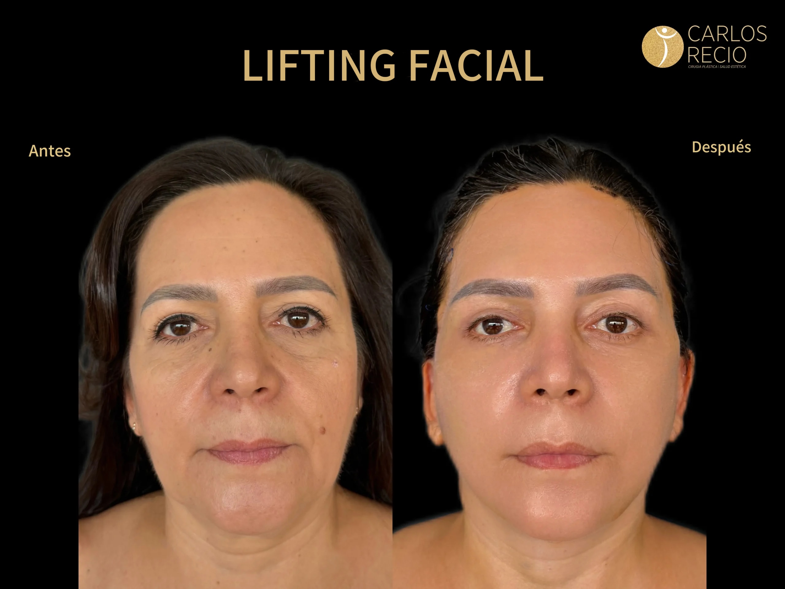 procedimientos faciales en Cali Lifting facial_2