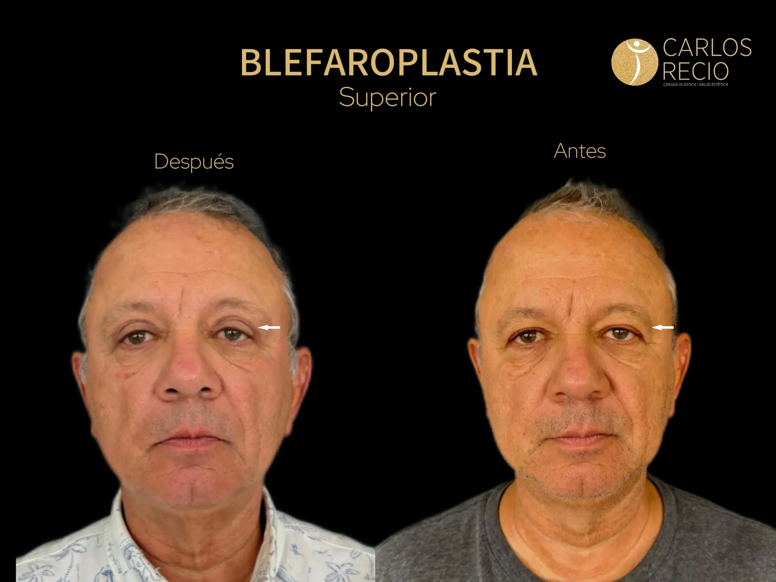 procedimientos faciales en Cali Blefaroplastia hombres