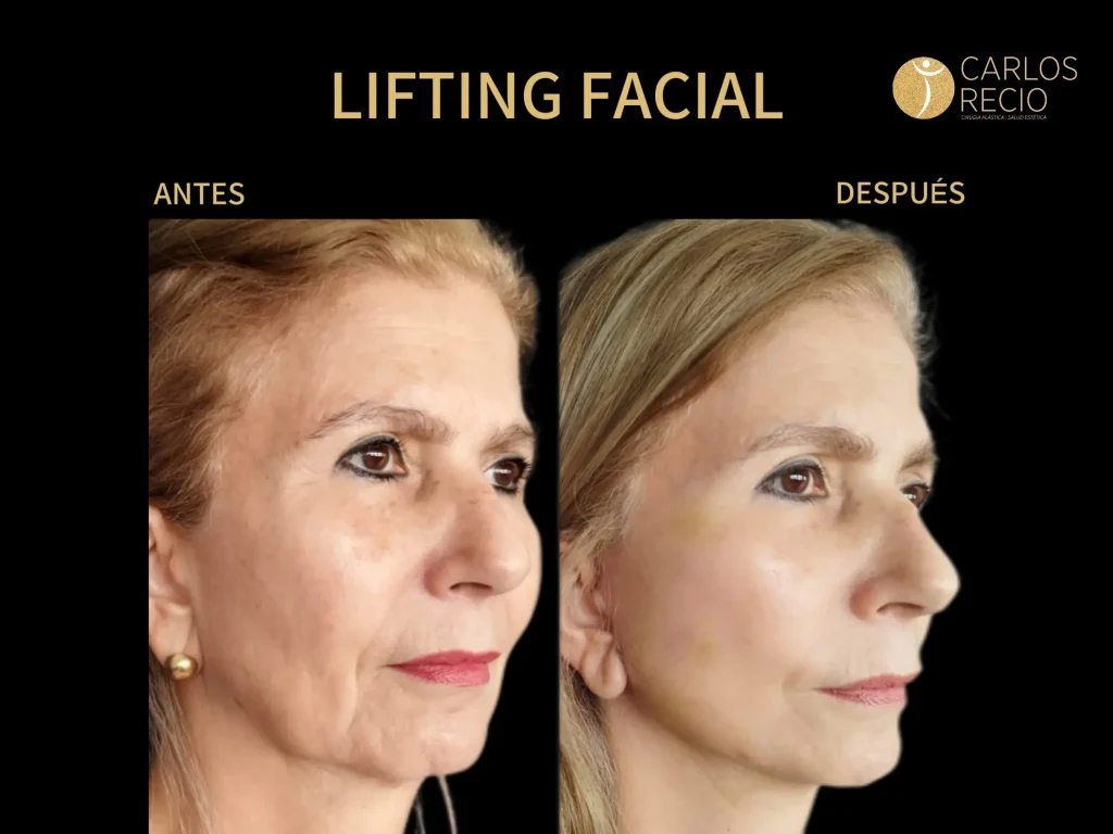 Deep Plane Facelift de Revisión: Cuando un Lifting Anterior No Dio el Resultado que Esperabas deep plane facelift