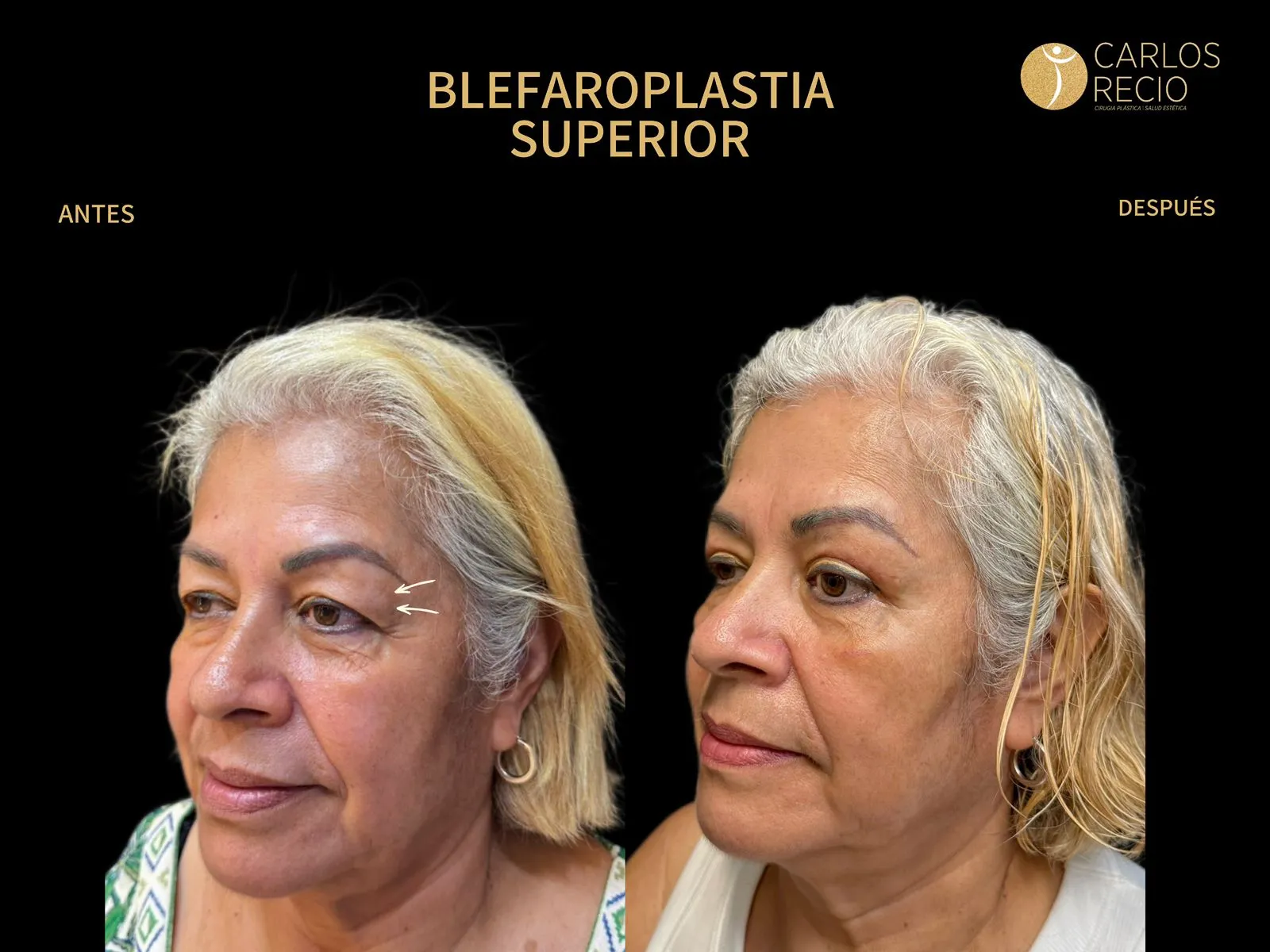 Blefaroplastia superior