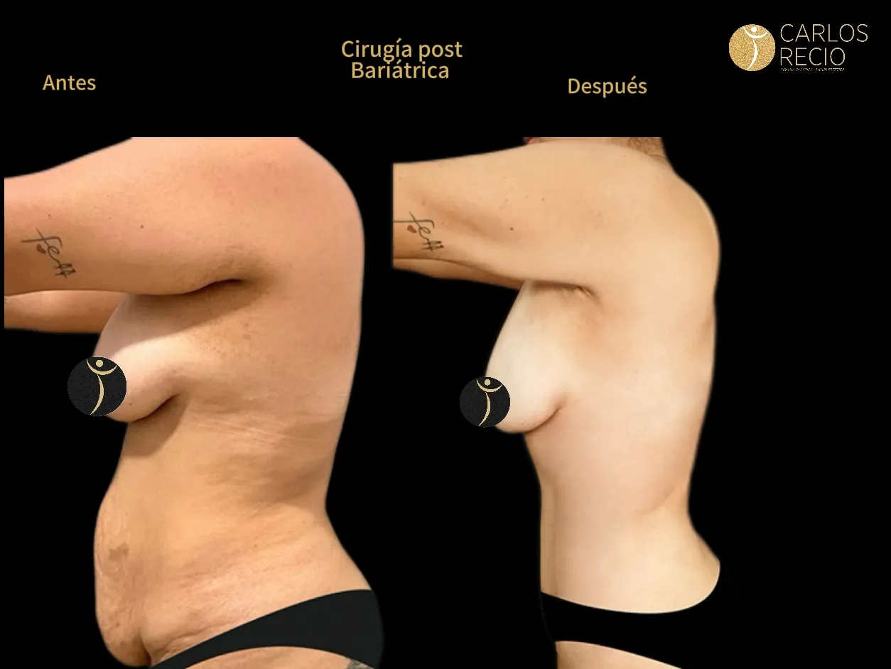 Cirugia reconstructiva post bariatrica POST-BARIATRICA