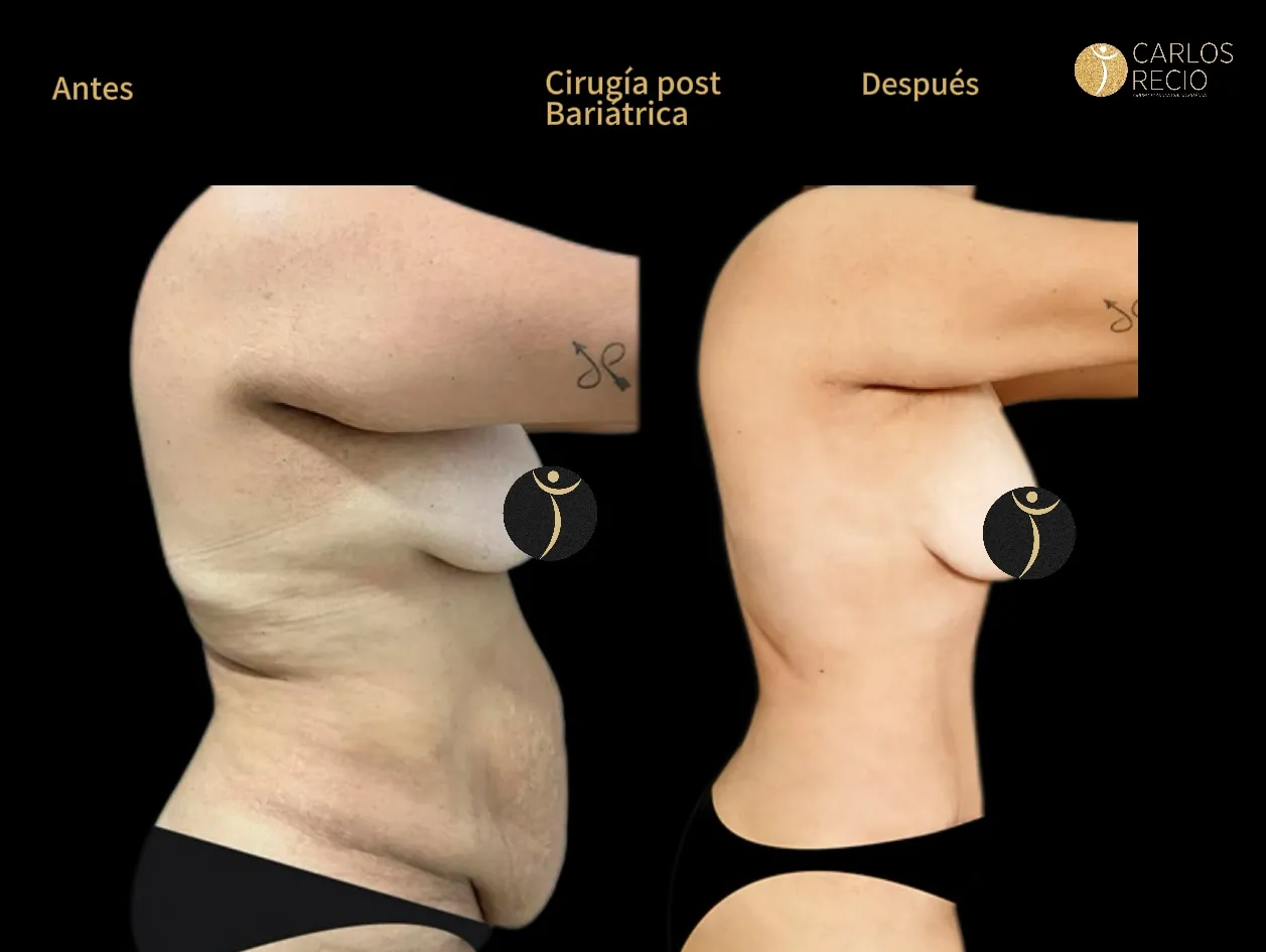 Cirugia reconstructiva post bariatrica POST-BARIATRICA