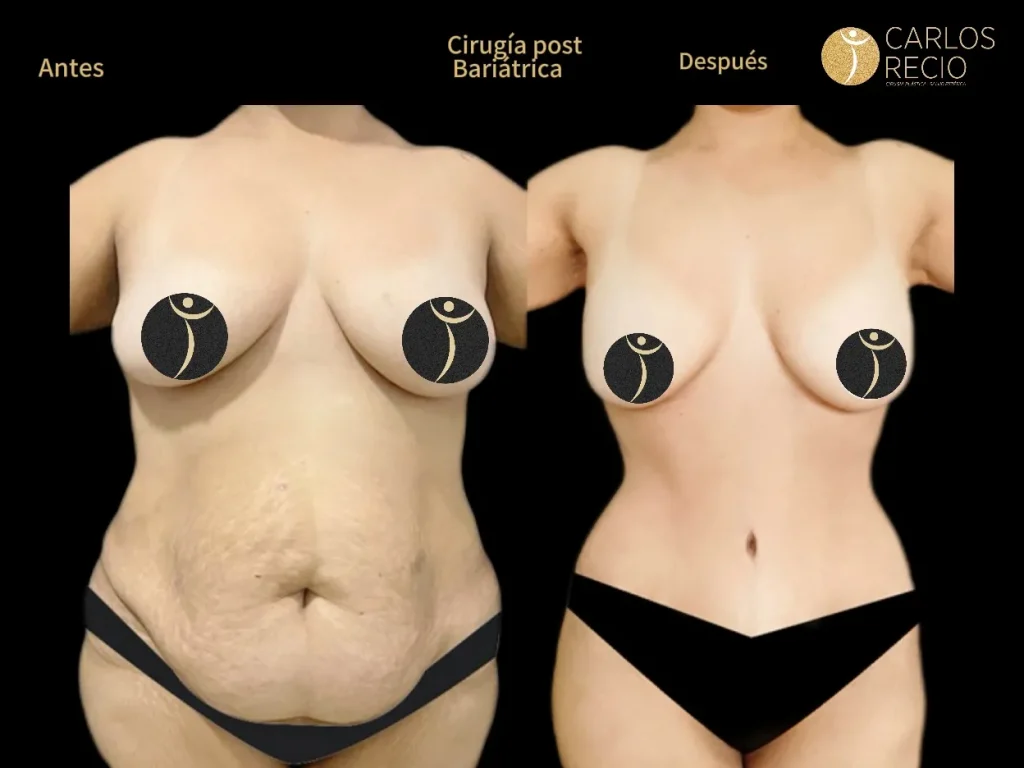 Cirugía post bariátrica en Cali: abdominoplastia y redefinición corporal tras la pérdida de peso Cirugía post bariátrica