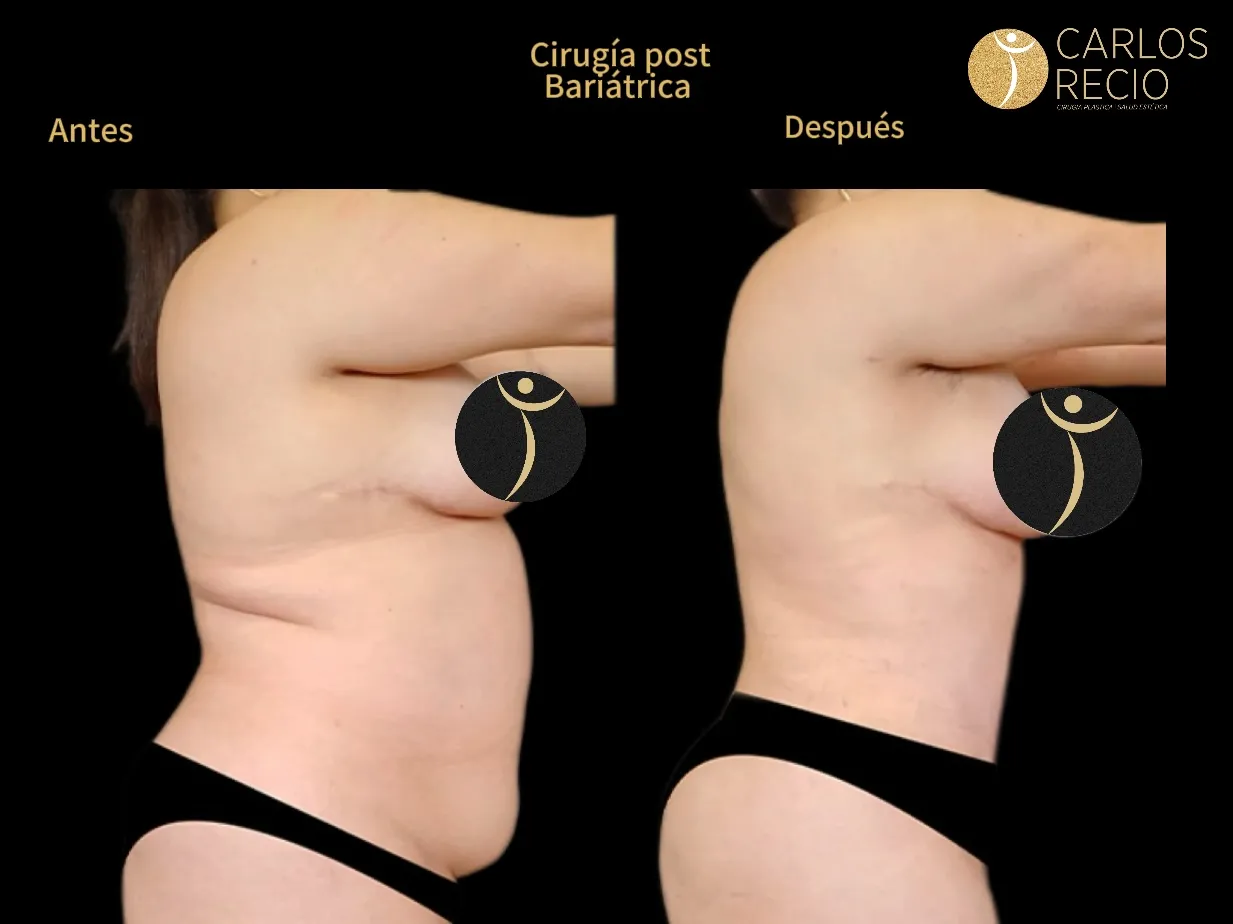 Cirugia reconstructiva post bariatrica Cirugía post bariátrica