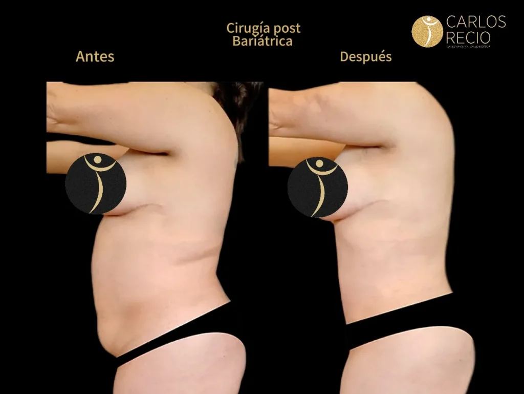 Lifting de Brazos en Cali: Braquioplastia para Eliminar la Flacidez del Brazo post-bariatrica- braquioplastia