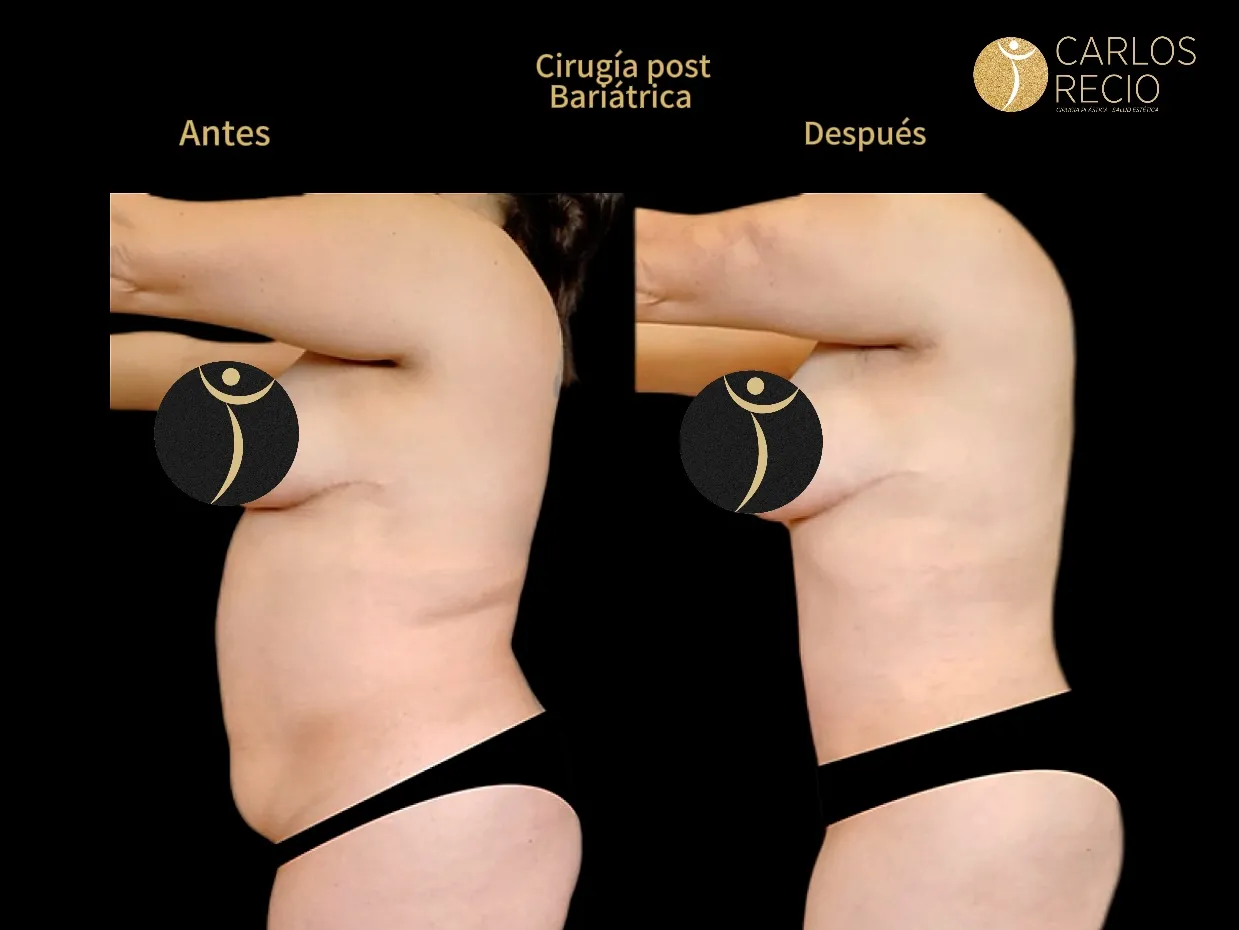 Cirugia reconstructiva post bariatrica post-bariatrica- braquioplastia