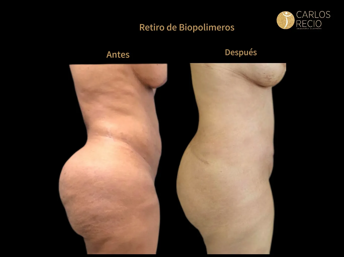 Retiro de Biopolímeros Retiro de Biopolímeros