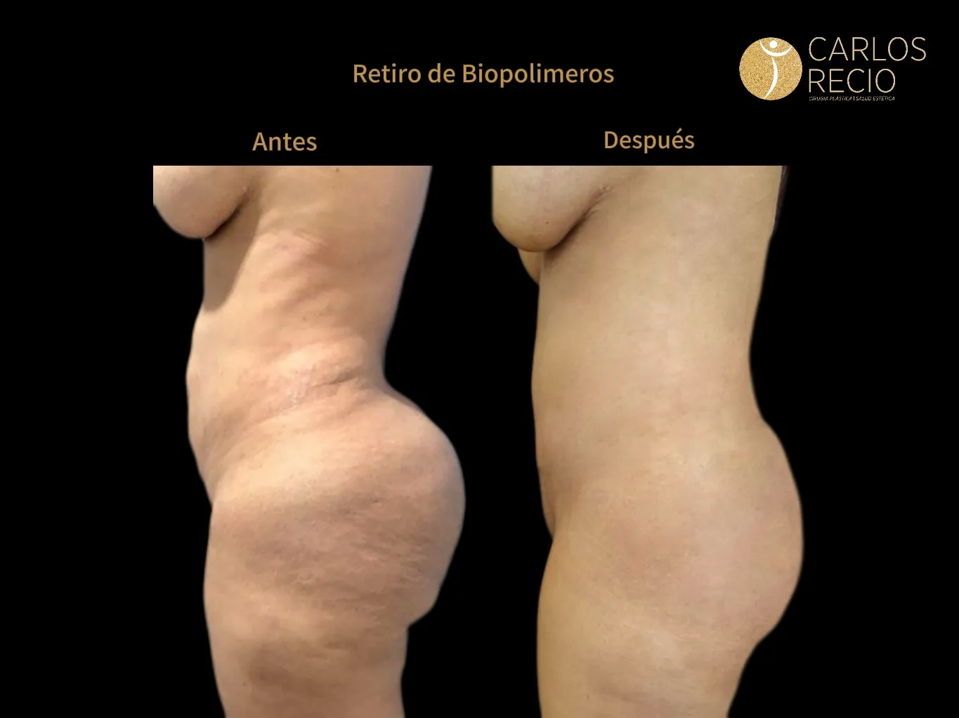 Retiro de Biopolímeros Retiro de Biopolímeros