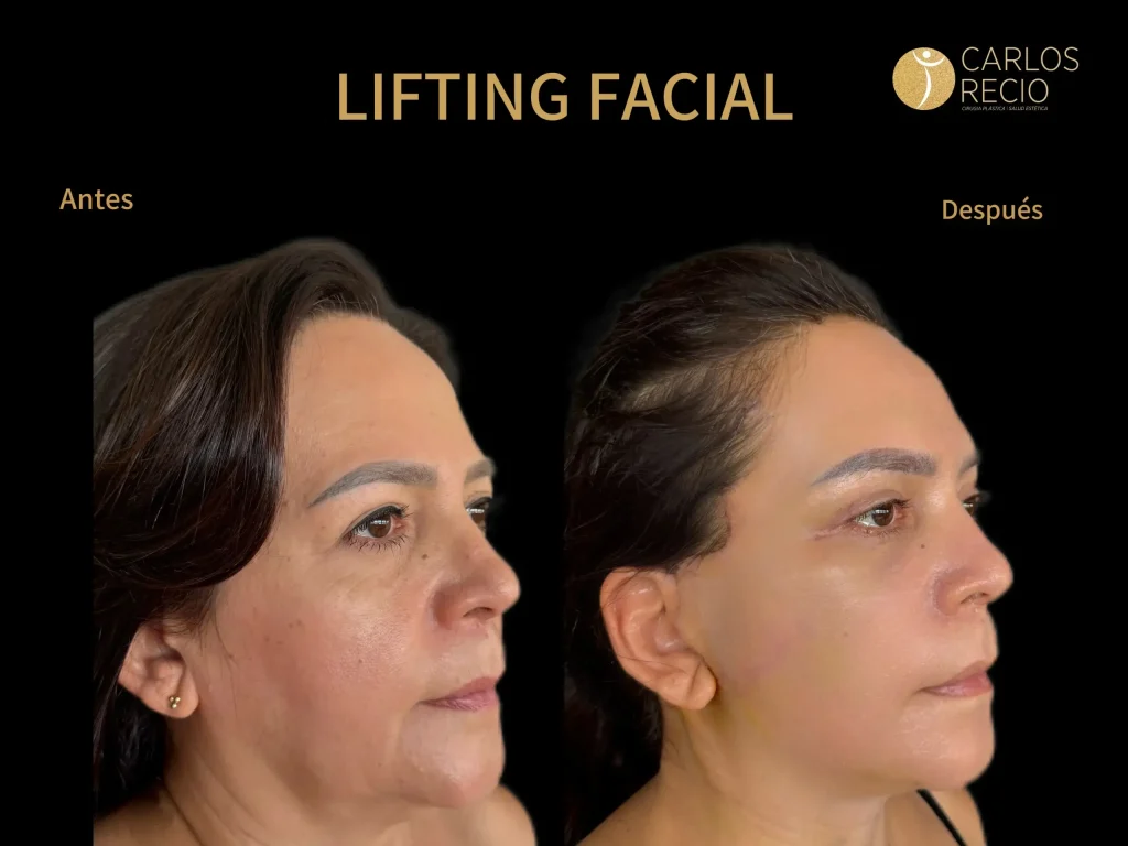 Por qué Cali es el Destino Preferido para Realizarse un Lifting Facial Por qué Cali es el Destino Preferido para Realizarse un Lifting Facial