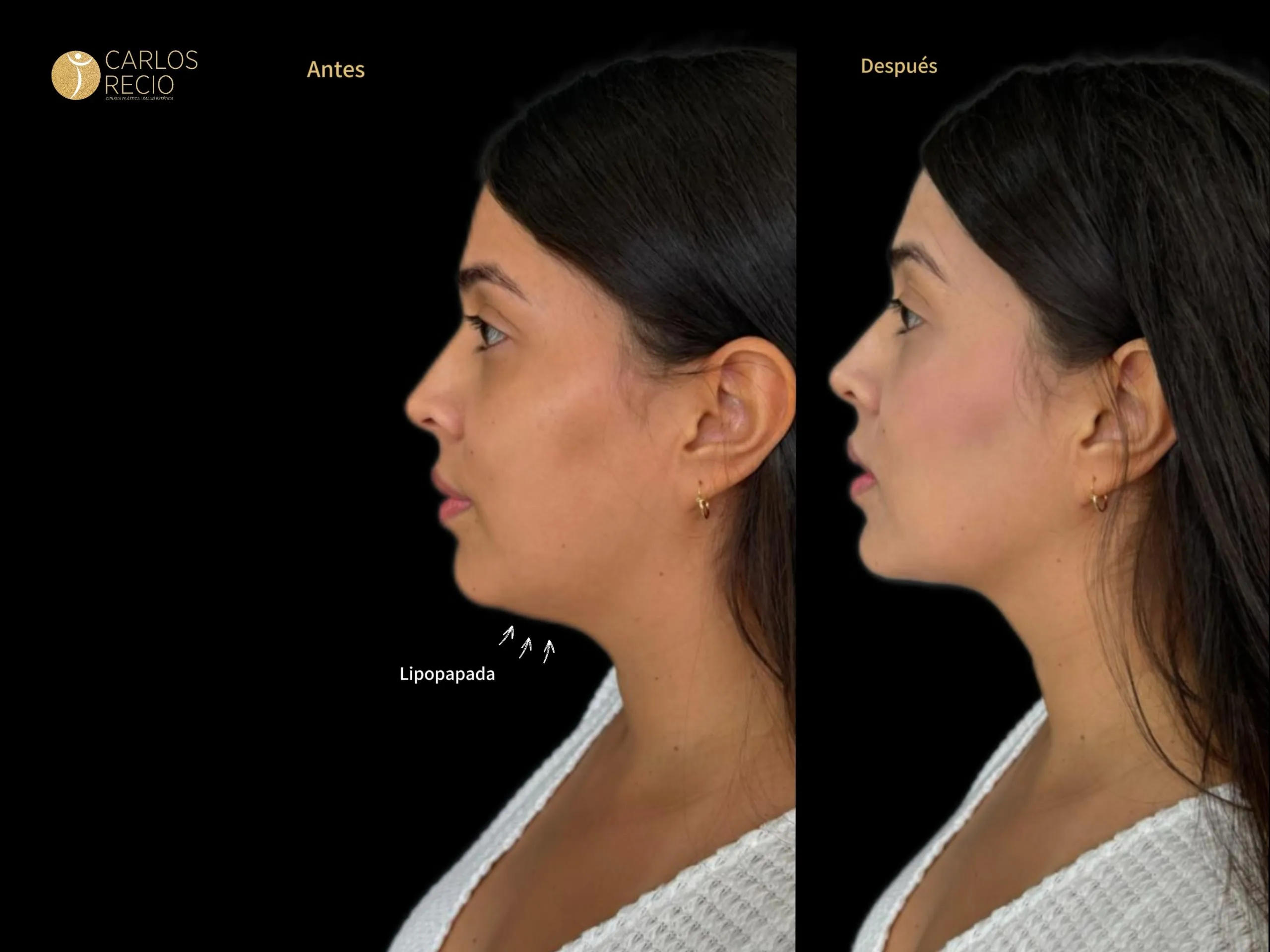 Liposucción de papada - Lipo-Papada lipopapada 2