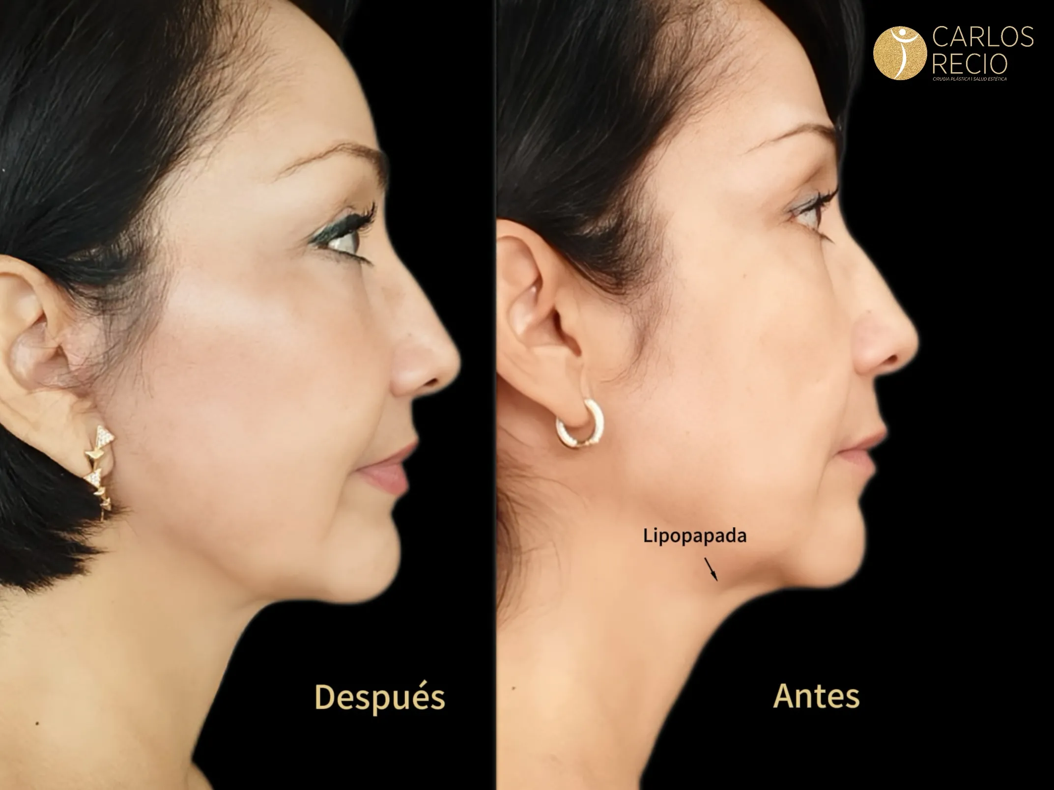 Liposucción de papada - Lipo-Papada lipopapada 3