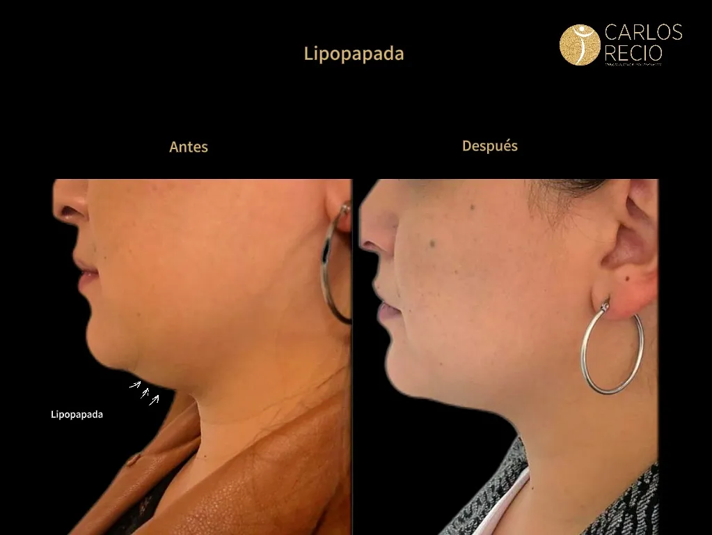 Liposucción de papada - Lipo-Papada lipopapada