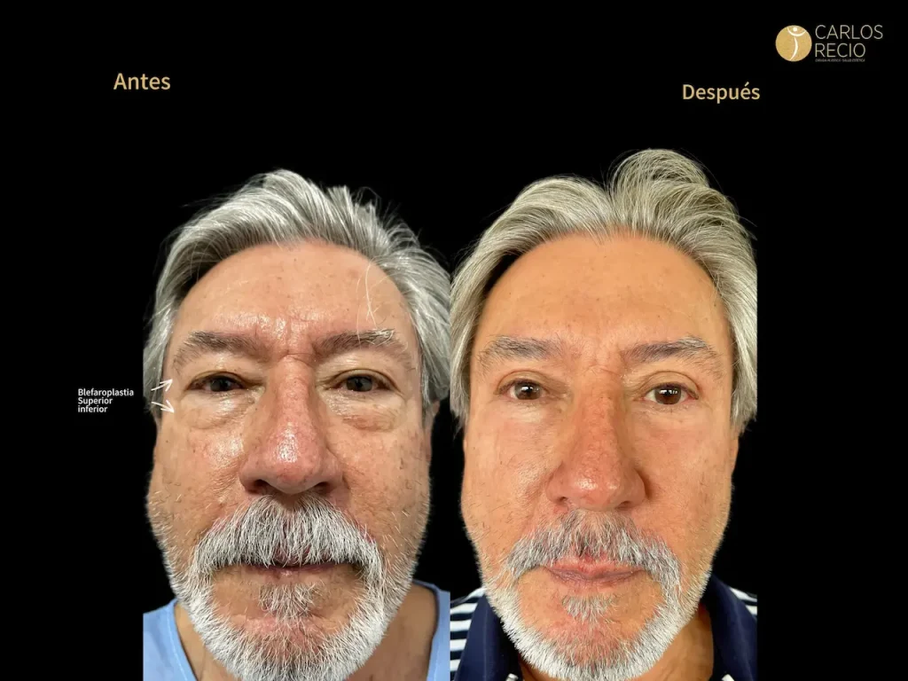 Blefaroplastia en Hombres: Mirada Descansada sin Feminizar el Rostro Blefaroplastia en Hombres: Mirada Descansada sin Feminizar el Rostro
