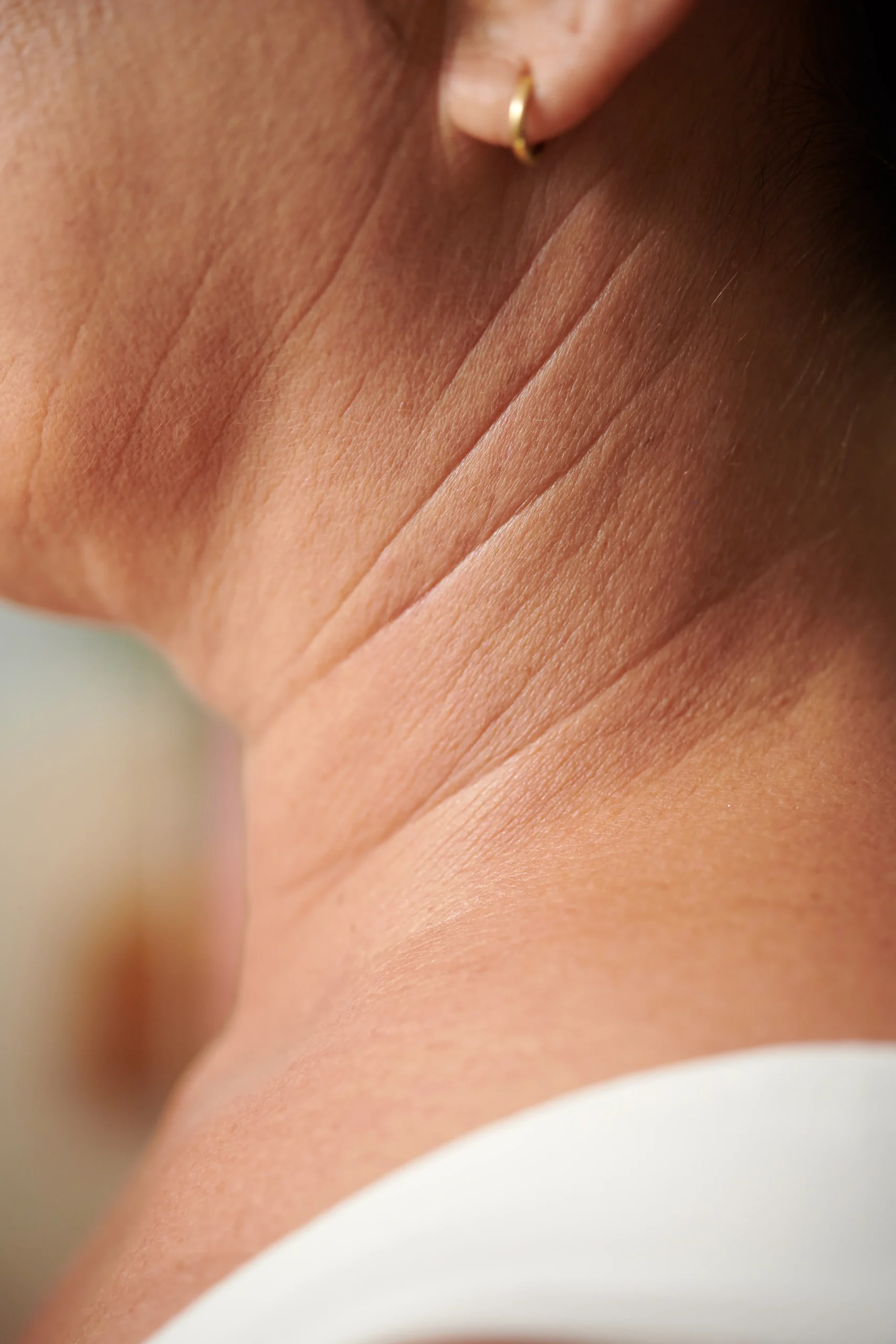 Lifting de cuello en Cali Bandas marcadas en el cuello