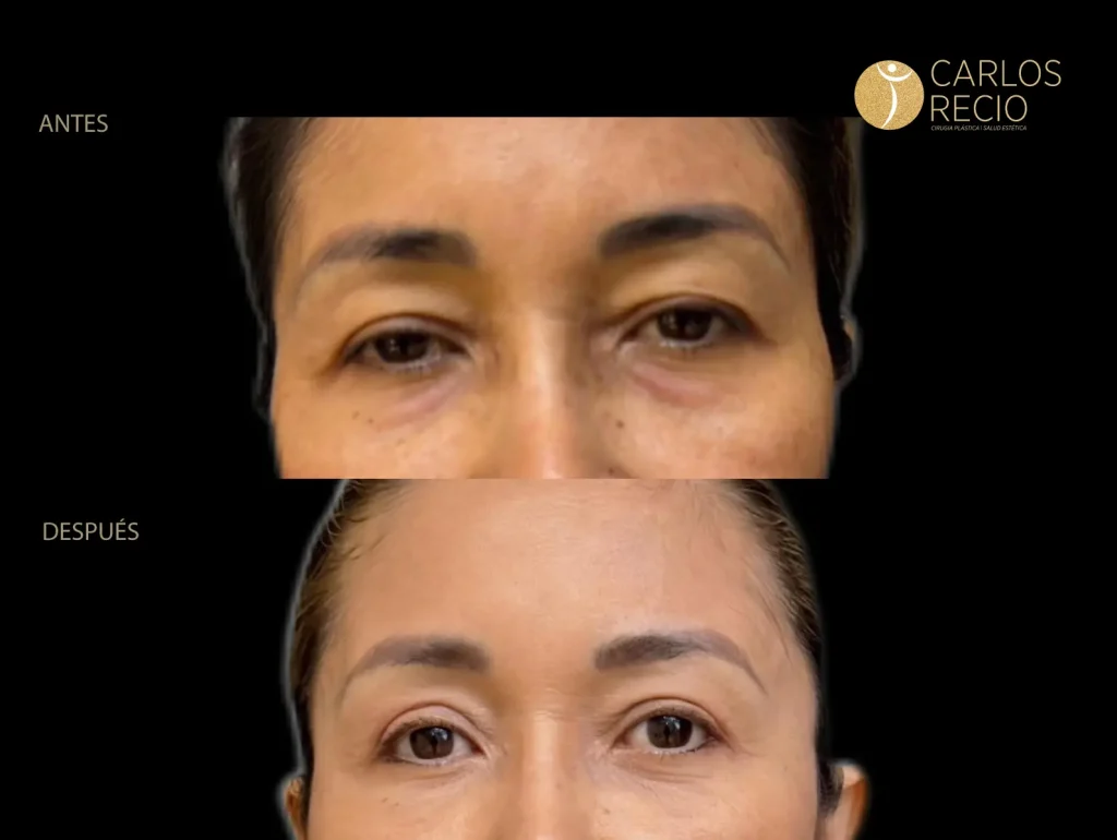 Blefaroplastia superior: cómo se realiza y cuándo es necesaria Blefaroplastia superior: cómo se realiza y cuándo es necesaria