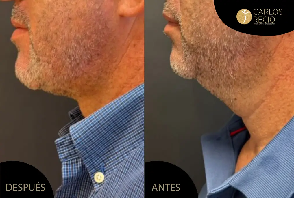 Lifting de Cuello en Pieles Muy Finas: Qué Cambia en la Planificación Quirúrgica Lifting de Cuello en Pieles Muy Finas: Qué Cambia en la Planificación Quirúrgica