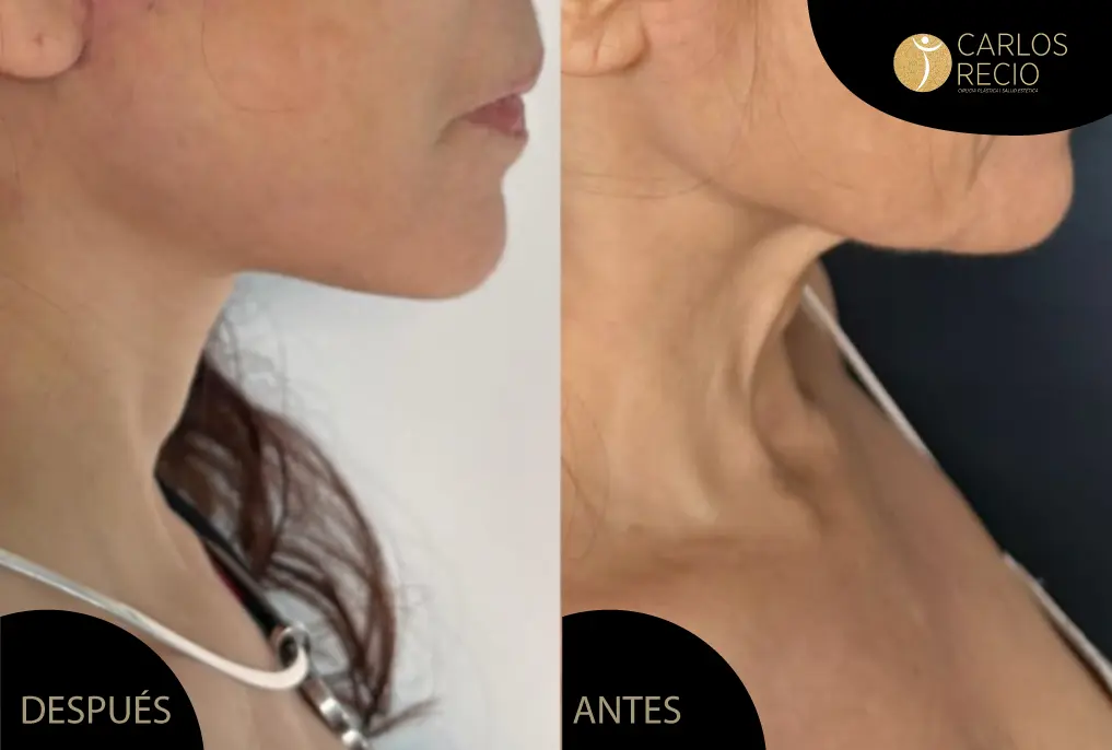 lifting de cuello