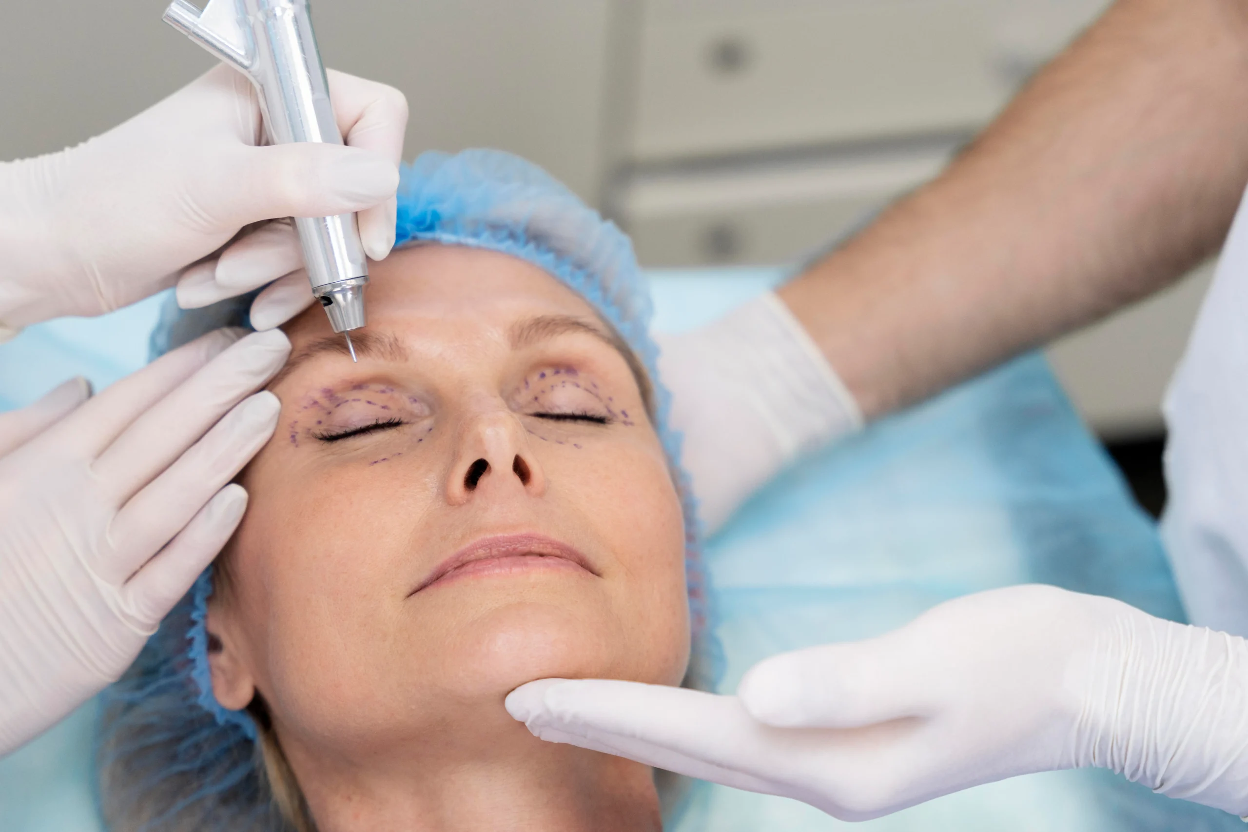 surcos nasogenianos cirugia facial