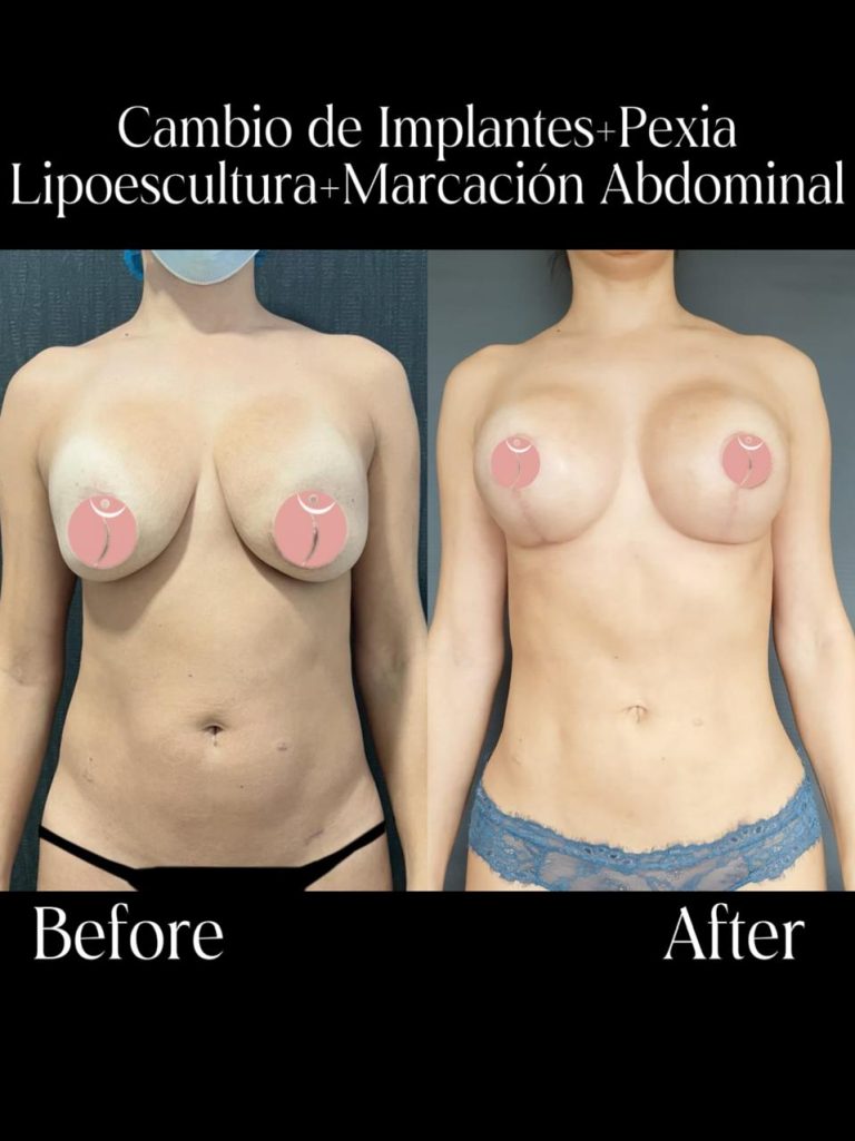 lipo precio