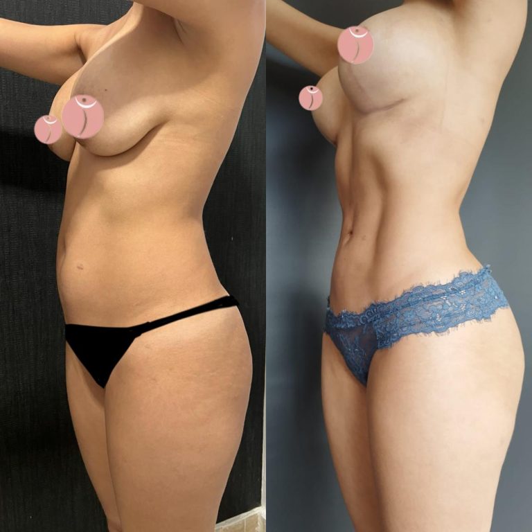 lipoescultura antes y despues