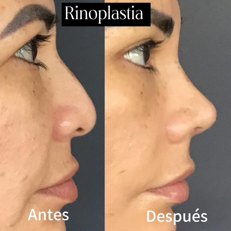 rinoplastia para nariz chata