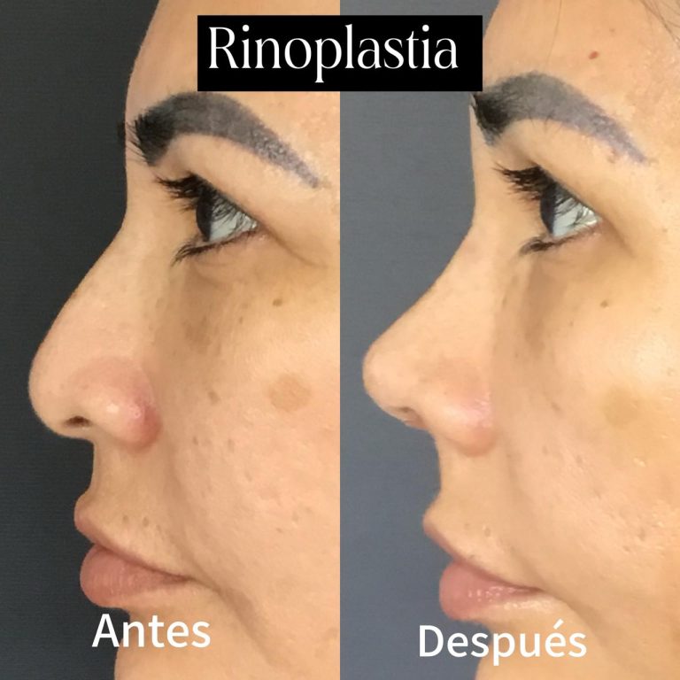 cirujano plastico rinoplastia