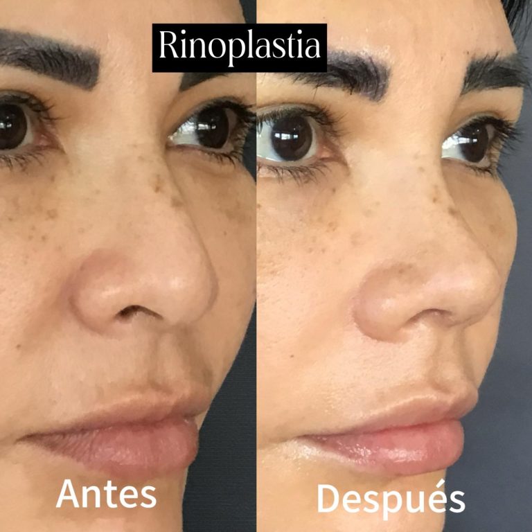 rinoplastia en cali